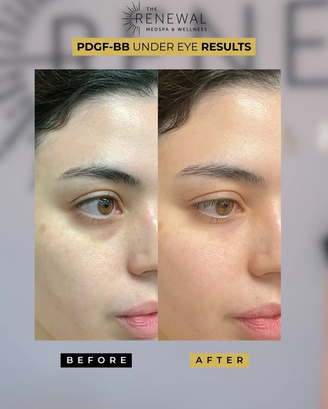 ✨ Eyes that look rested - without makeup, filters, or filler ✨
This client&rsquo;s under-eye transformation is thanks to PDGF-BB, a regenerative treatment that stimulates collagen, strengthens skin, and smooths discoloration for a brighter, more refr