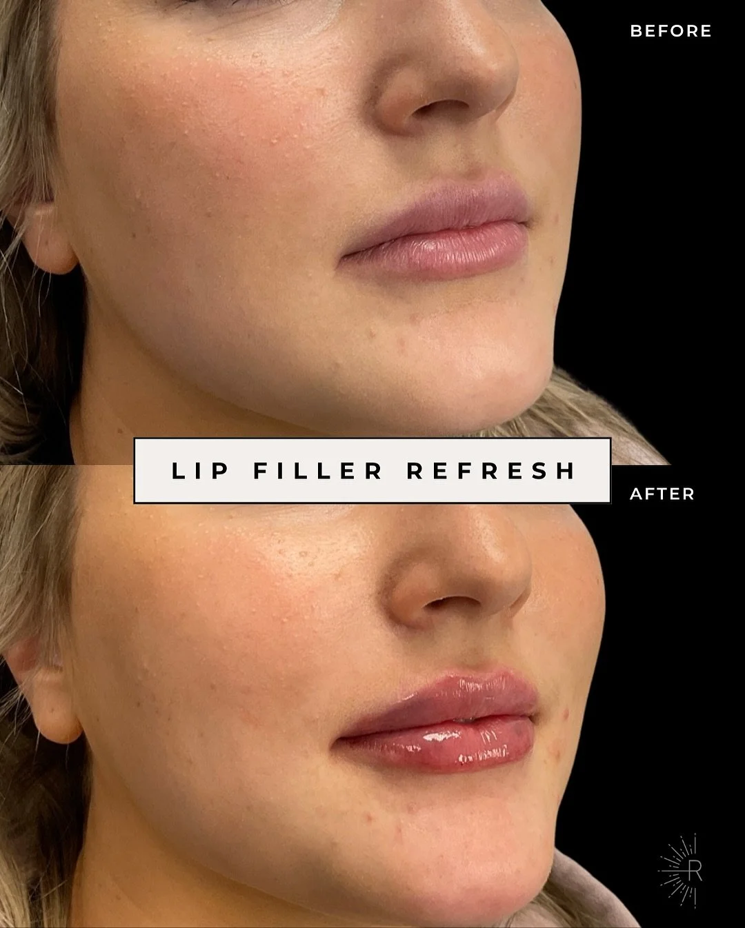 ✨ Lip Filler Refresh ✨

This client came in for a subtle lip refresh - focusing on:
💋 Crisp, defined borders
💧 Restoring hydration and glow
🔄 Evening out natural asymmetries
💉 Just a touch of plump for balance

The result? Refined lips that still