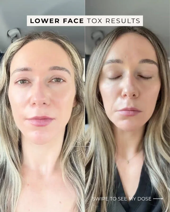 Your forehead says 30s&hellip;but your lower face says 40s. 👀
That&rsquo;s why lower face tox matters 💉

Balance = natural.
Harmony = anti-aging that makes sense.

✨ Treat the whole face &rarr; stay in the same decade ✨

🔗Link in bio to book your 