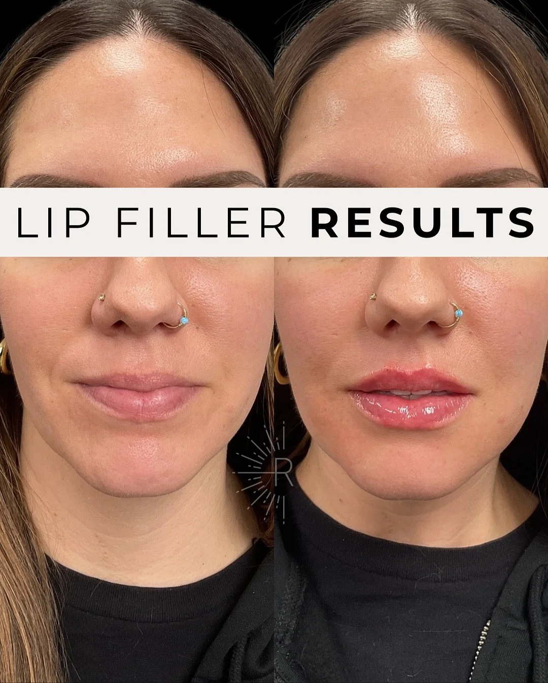 💋 First time lip filler + naturally enhanced ✨

This beauty wanted a soft, hydrated look with a little extra definition&mdash;without looking &ldquo;done.&rdquo; The result? Lips that are still her, just refreshed and balanced. 💋

At The Renewal, o