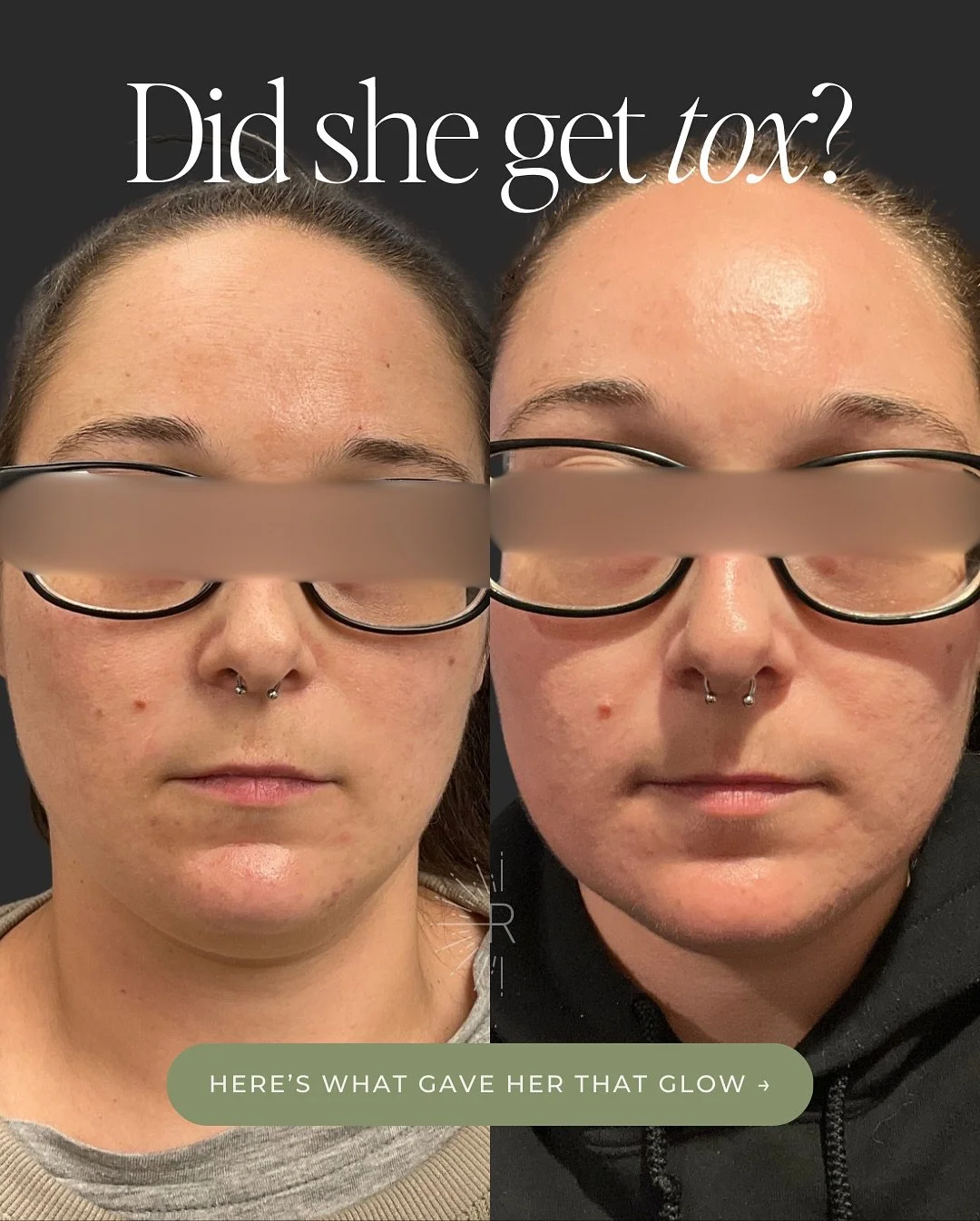 ✨ Did she get tox? Nope - just skincare🧴🫧

Less than one week apart, and the difference speaks for itself 🤍 (I couldn&rsquo;t even believe it myself!)
Her melasma, texture, fine lines, and tone all improved - no injectables, no filters, just a cus