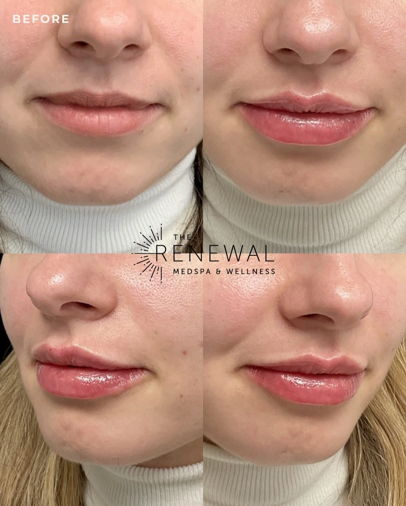 A first-time lip filler moment ✨💋
She wanted a soft, natural enhancement &mdash; just a little more shape, hydration, and balance&hellip; and we delivered exactly that. No overdone look, no heaviness. Just her lips, but better. 🤍

A gentle boost ca