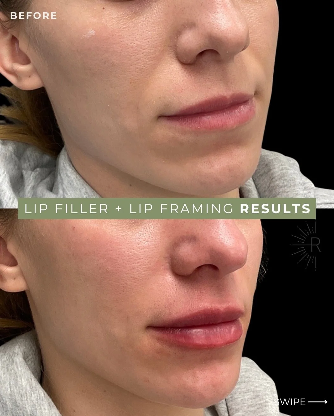 Not your average lip filler appointment 💖

Always assessing if you need support in your pyriform (bony prominence next to either side of the base of the nose) to then support your nasolabial folds and help pop that line up. Also if you&rsquo;re look