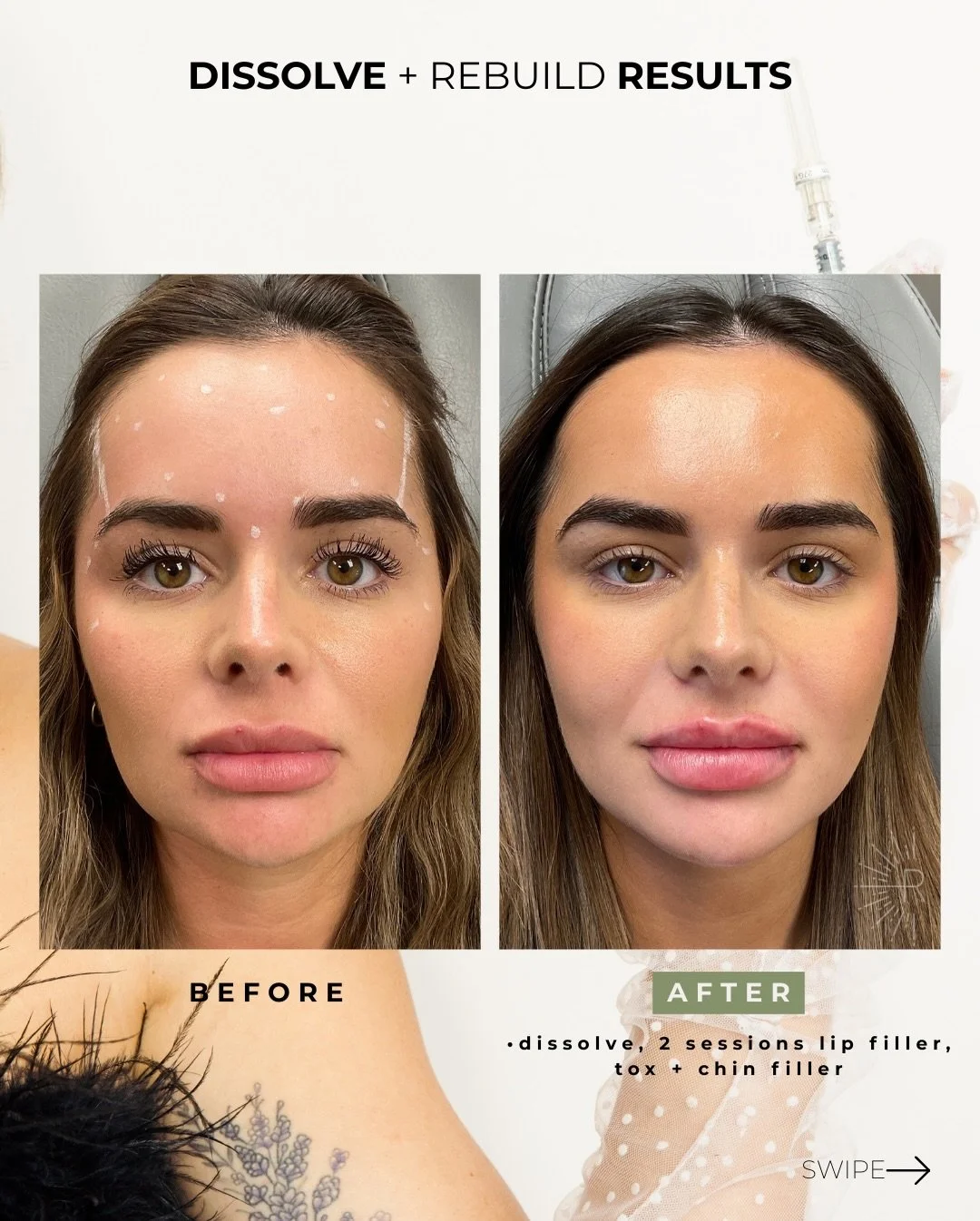 DISSOLVE + REBUILD 🤍
Swipe to see the full breakdown ➡️

This client originally started her lip journey with me - but in between visits, she saw a different provider

After that appointment, she began feeling lumps and bumps inside her mouth along t