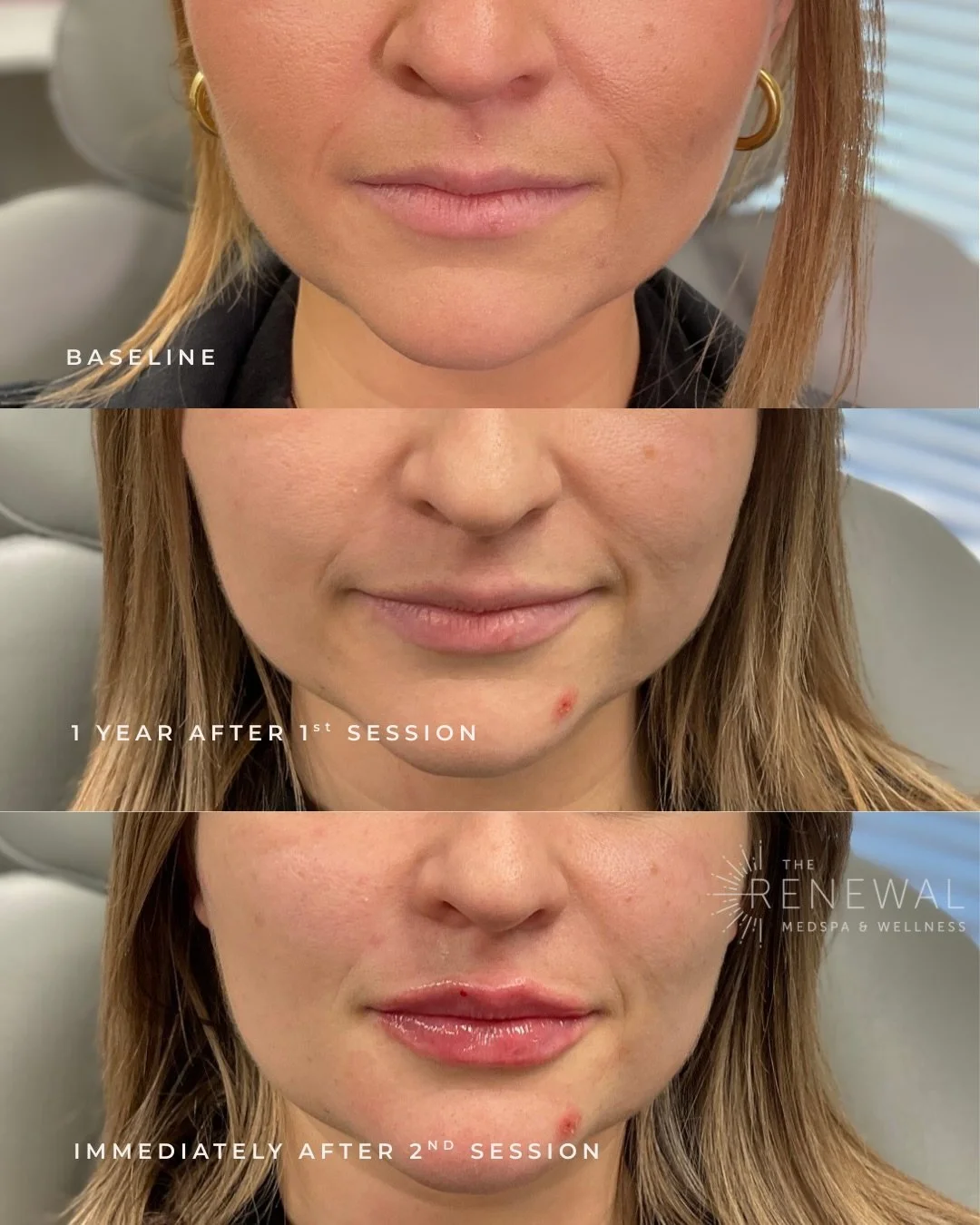 ✨ Lip Filler Progression ✨

Beautiful lips aren&rsquo;t always created in a single appointment - they&rsquo;re strategically built over time🕓

This progression shows:
&bull; Baseline
&bull; 1 year after the first session
&bull; Immediately after the