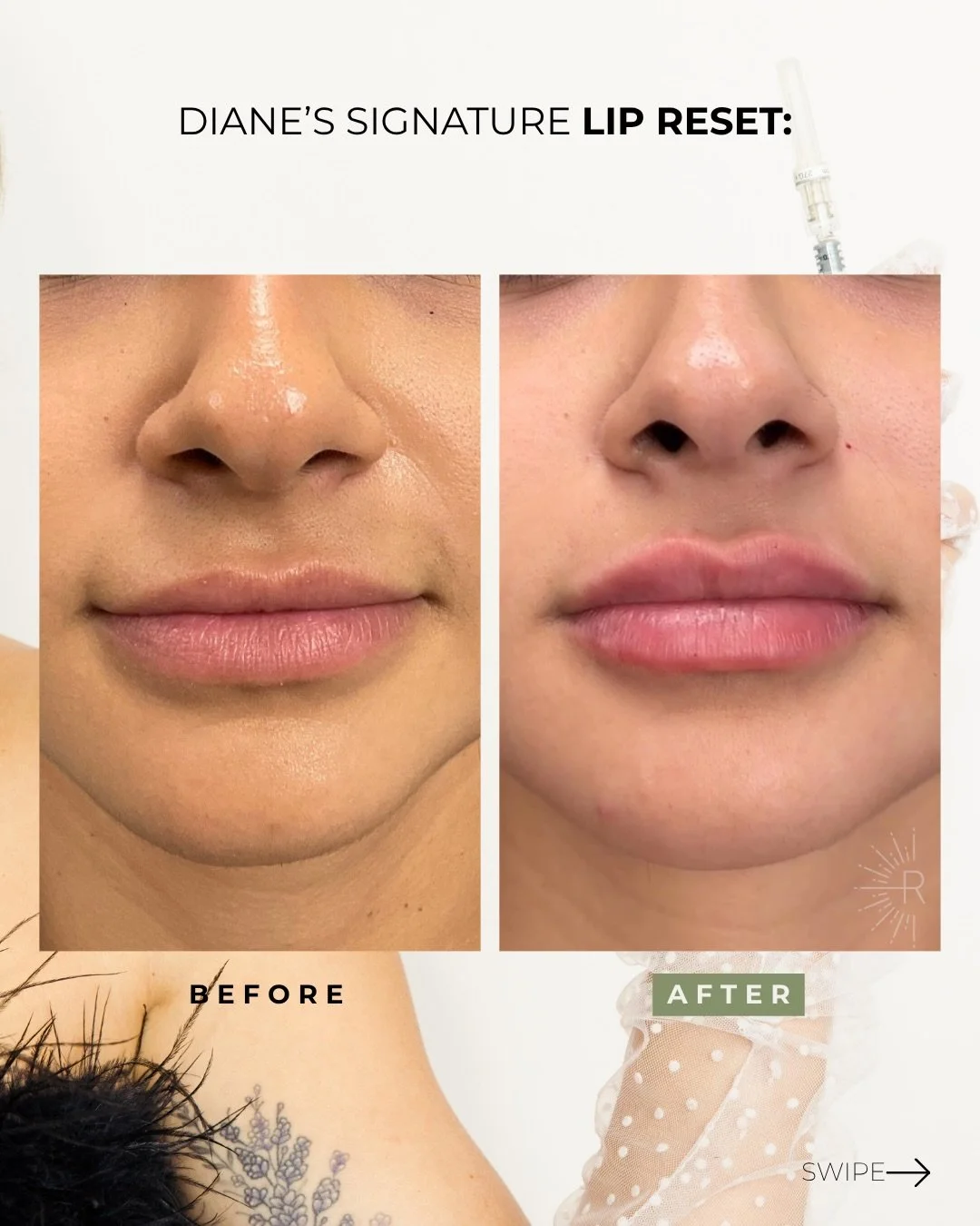 And this is what no one talks about &mdash; the reset phase✨

Because the glow-up doesn&rsquo;t happen by covering it up&hellip;
it happens by doing it RIGHT.

2nd photo shows her baseline (migration), fully dissolved, and then after my signature lip
