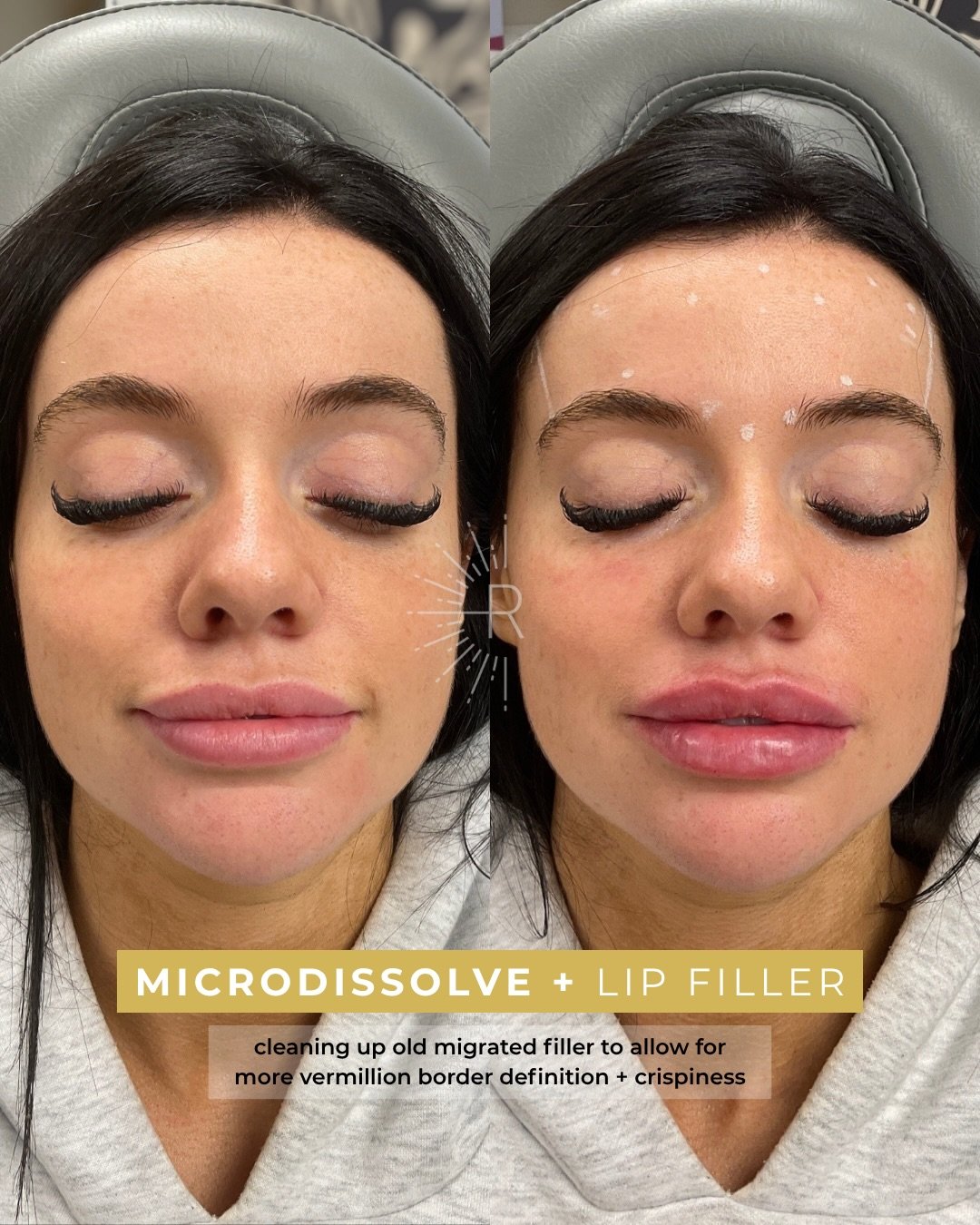 Sometimes we can do a little cleanup while augmenting the lips, sometimes it&rsquo;s a full dissolve and start fresh situation 💉

In this patient&rsquo;s case we were able to microdissolve migrated filler outside of her vermillion border carefully w