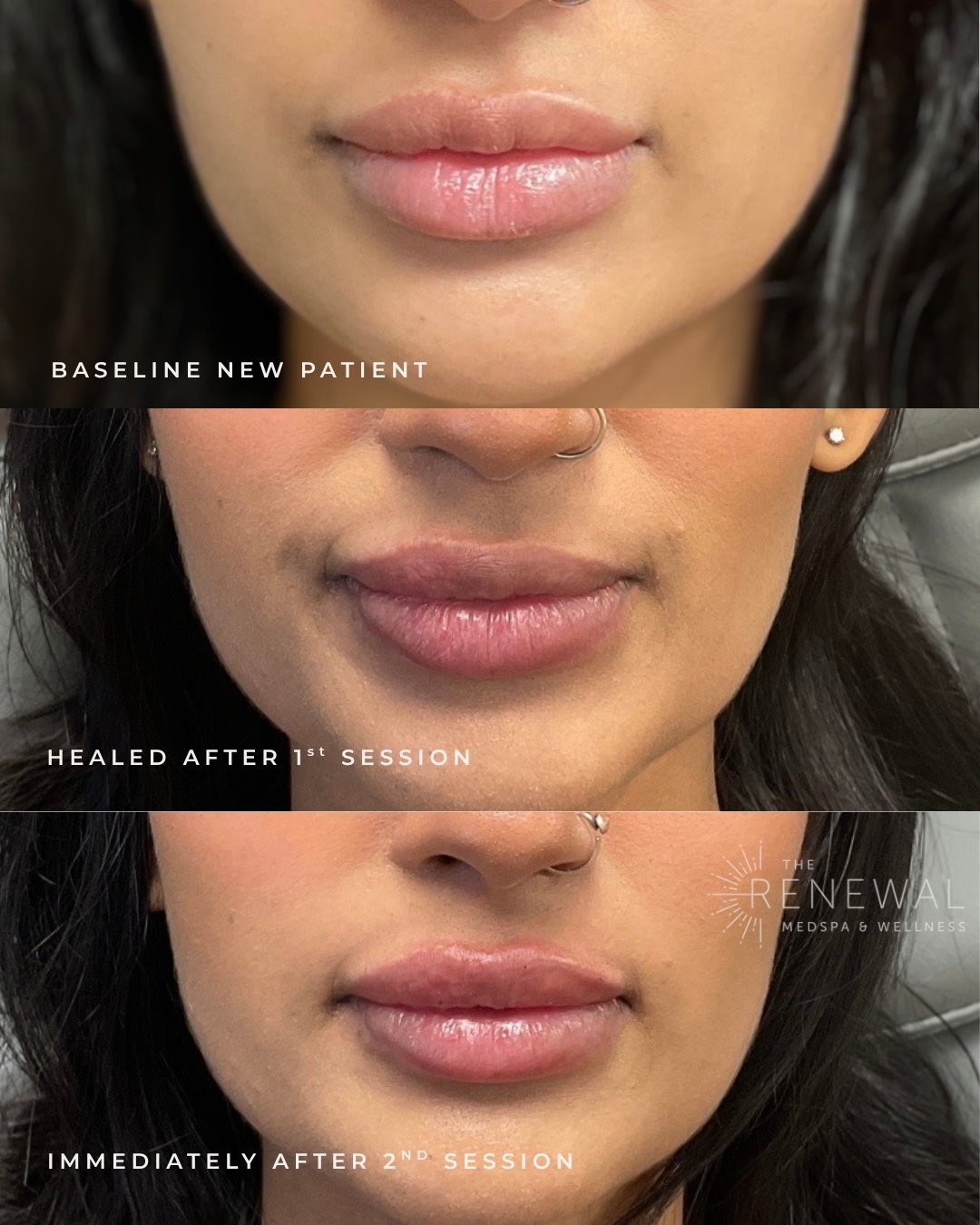 Let&rsquo;s build the lips you&rsquo;ve been waiting for 🥰💕

Baseline new patient ➡️ microdissolve + lip filler ➡️ 2nd round of lip filler ✨

❌No more bubbles or lumps/bumps in the middle portion and lower part of upper lip &mdash; instead we have 