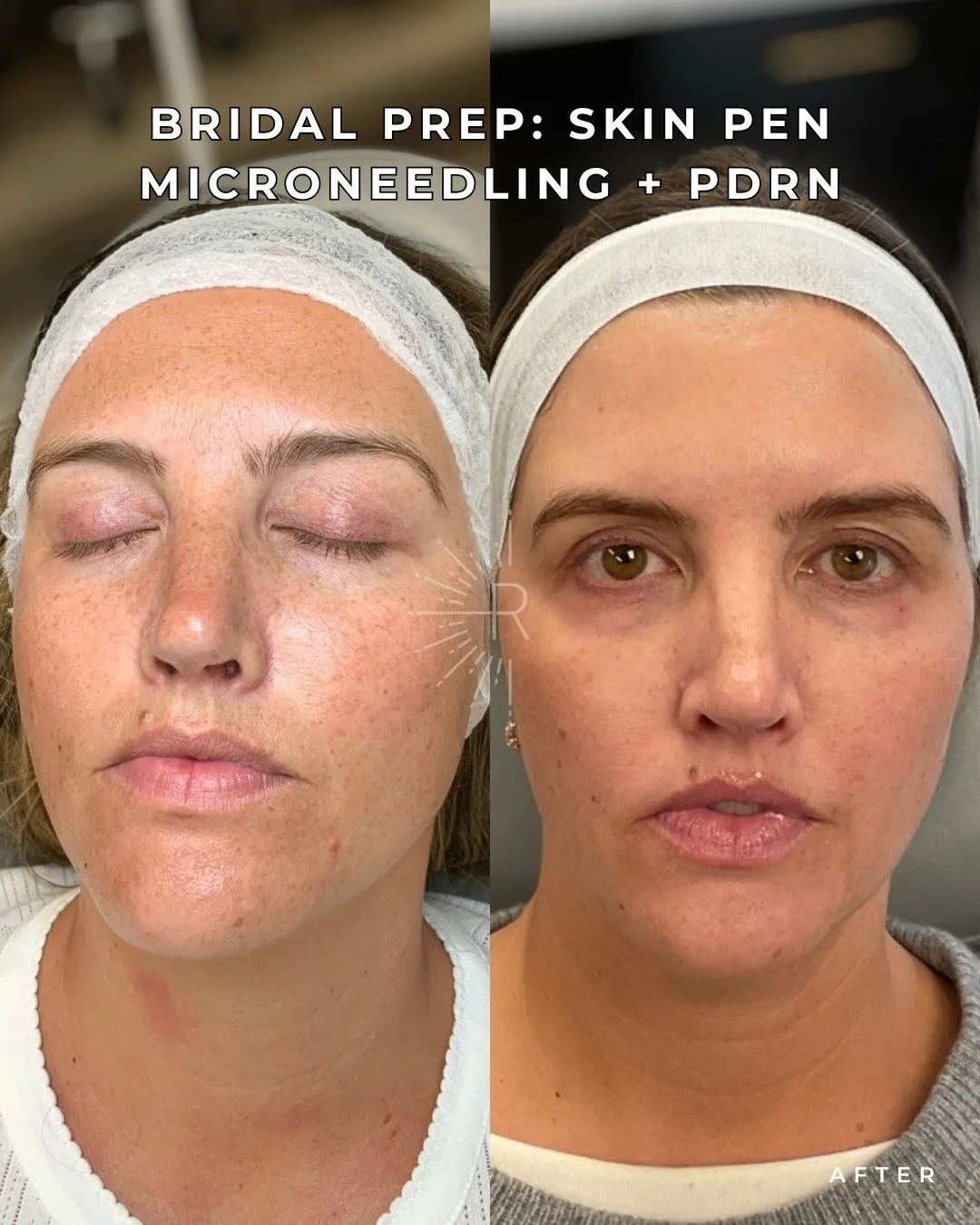 ✨ BRIDAL PREP THAT DELIVERS RESULTS ✨

These results are after 3 sessions of SkinPen Microneedling + PDRN (salmon DNA).

✔️ Smoother texture
✔️ More even skin tone
✔️ Brighter, healthier-looking skin
✔️ Improved collagen stimulation
✔️ Skin that allo