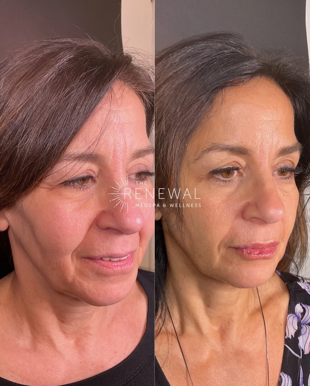 Sculptra Before & After