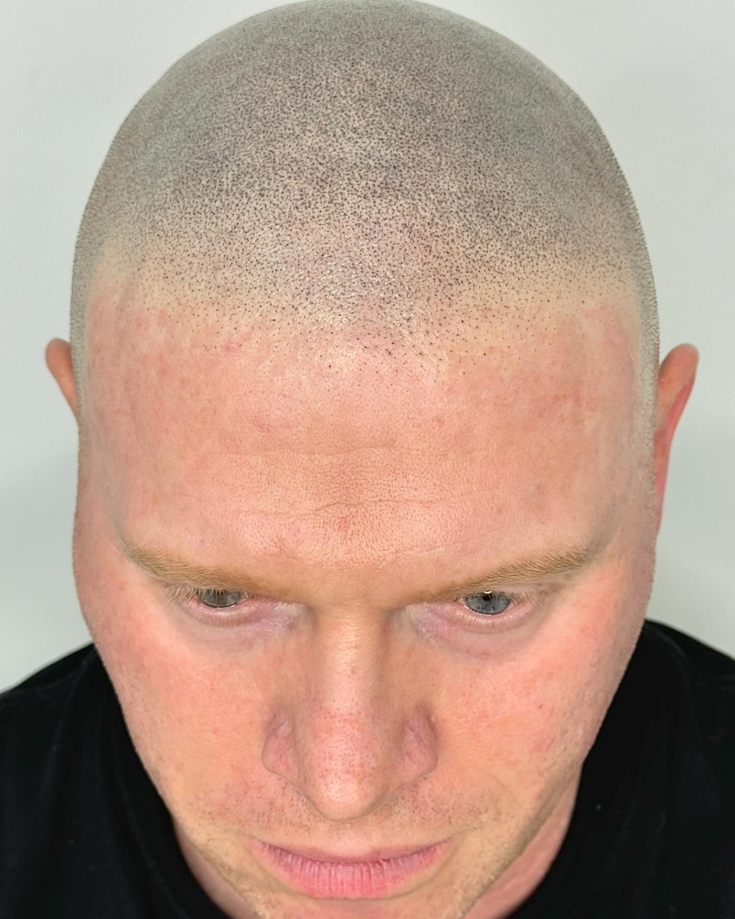 Swipe right to see a before and after on my client. After 3x sessions we finished with a nice soft natural hairline, suiting his facial structure. We also re designed his sides , bringing them closer to his face to compliment  his features nicely 🙌?