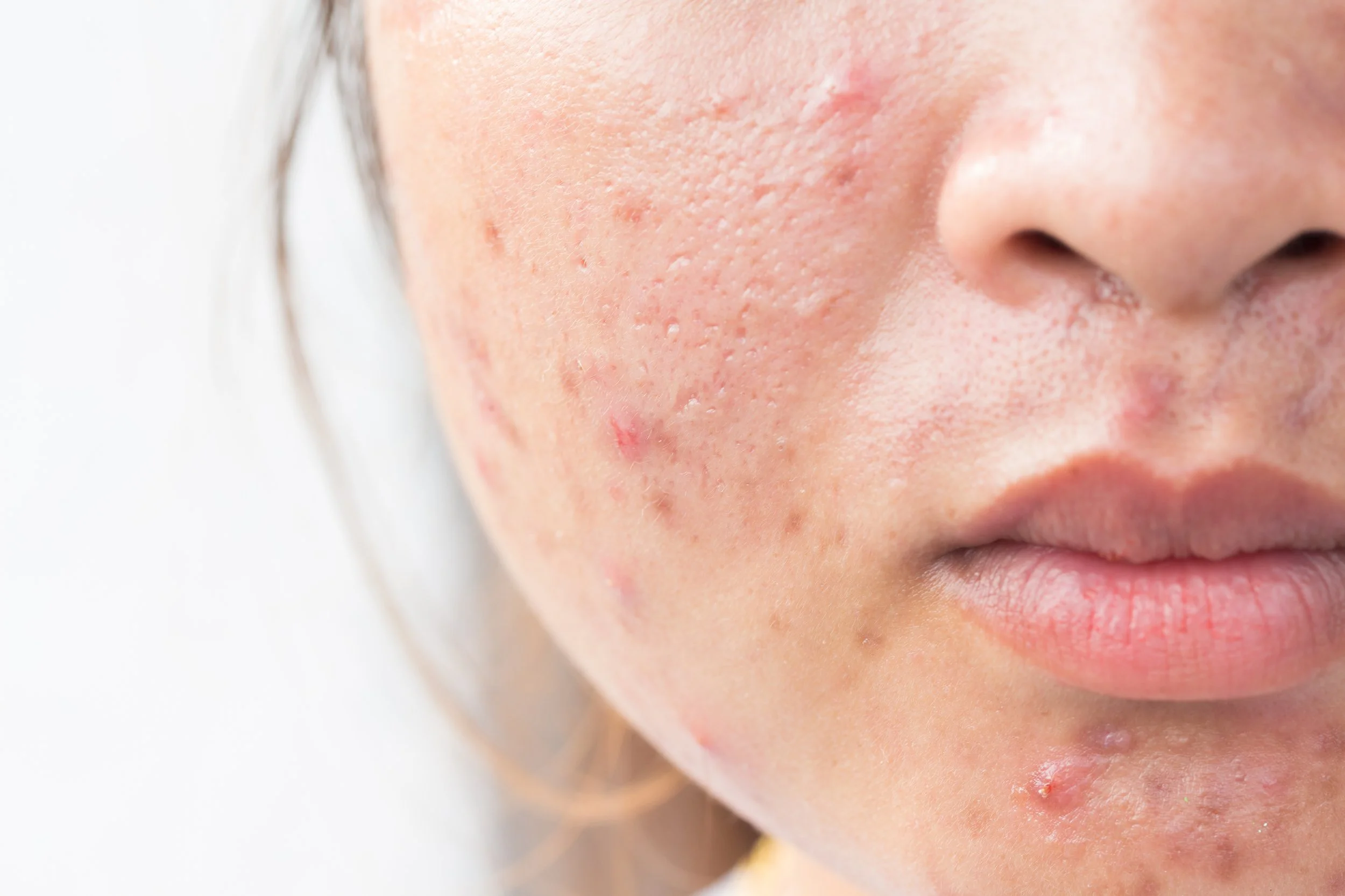 Treating Acne with the Aerolase Laser