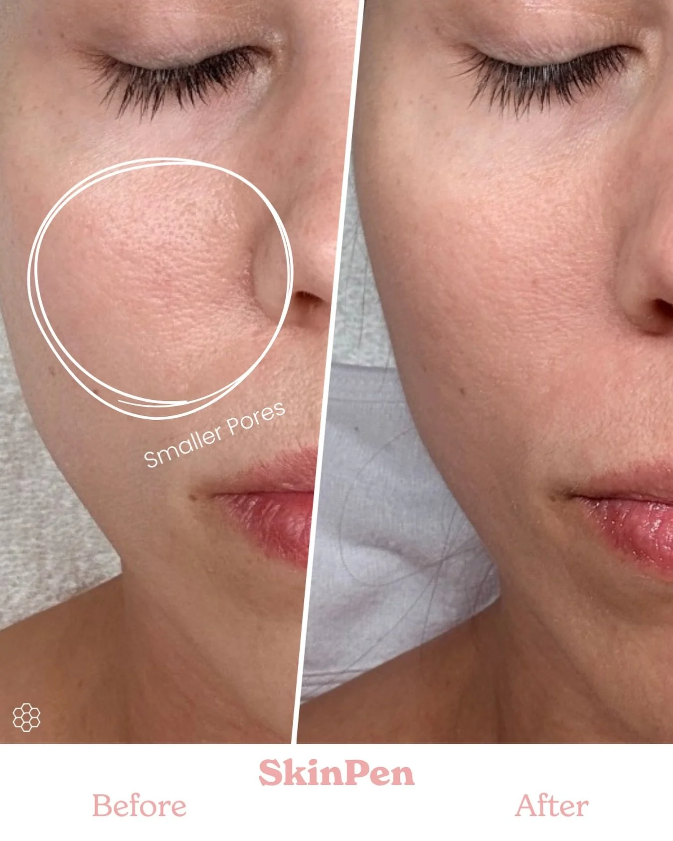 ✨ Get 10% off your first SkinPen treatment. Use code SweetSkinPen at booking. ✨ These results are after just ONE treatment &mdash; with the after photo taken 6 weeks later. SkinPen works by stimulating collagen, which means the skin continues to impr