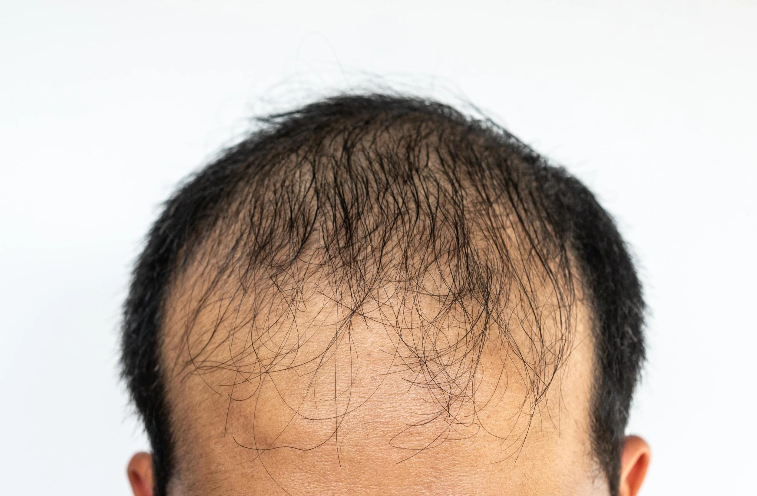 Understanding the Causes of Hair Loss in Men
