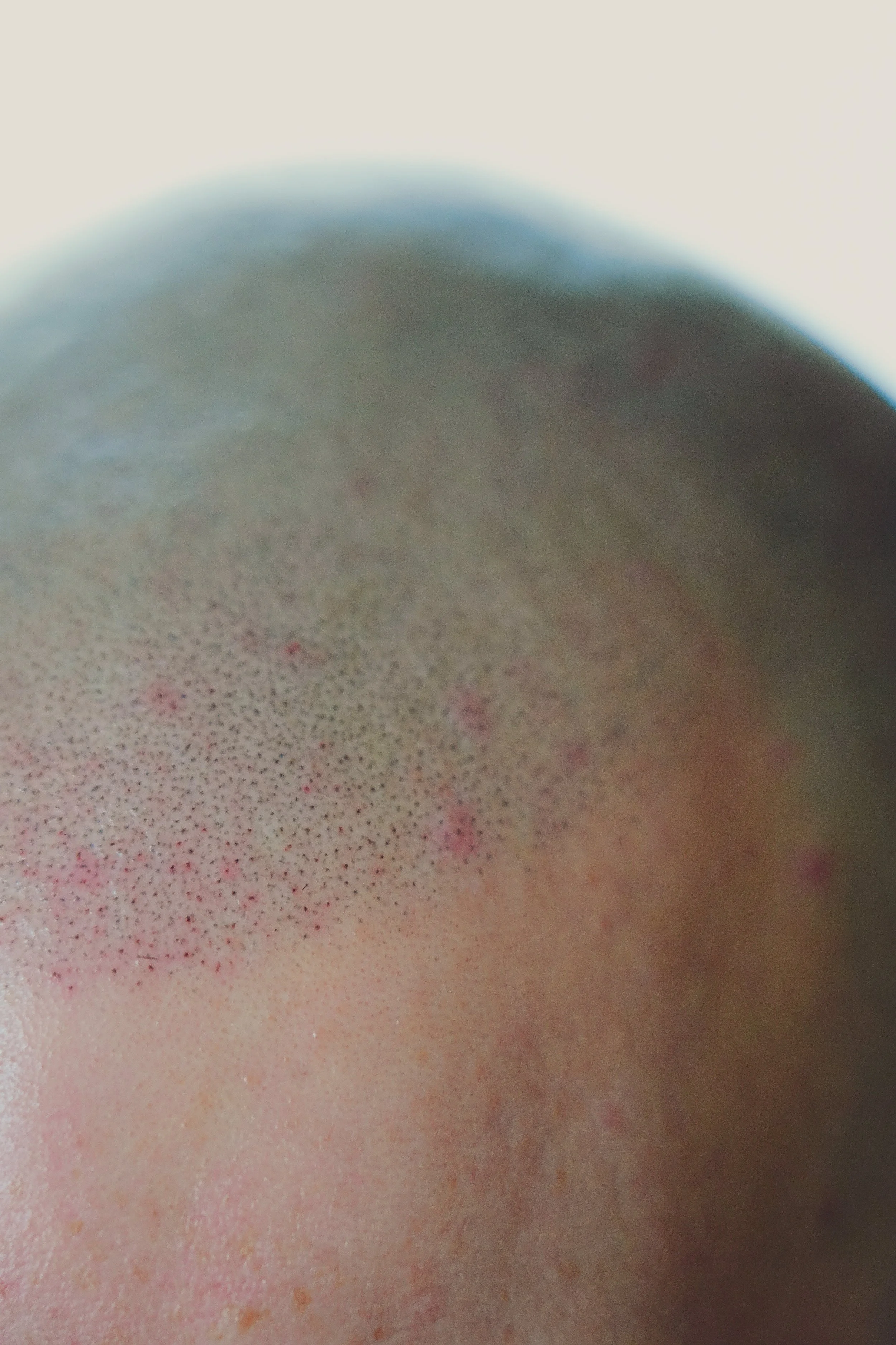 Does Scalp Micropigmentation Look Natural? An Honest Answer
