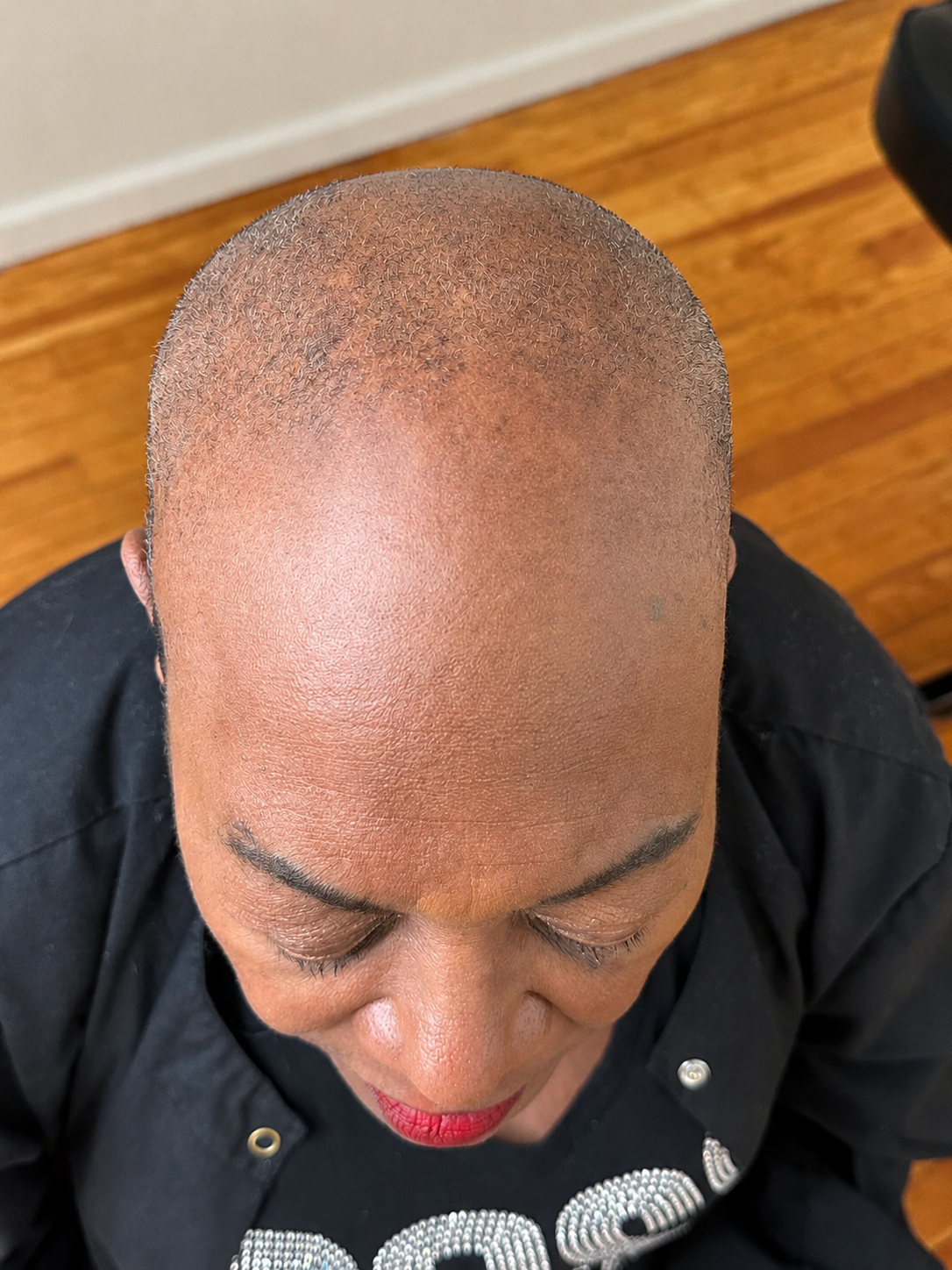 Scalp Micropigmentation for Alopecia: Why it Works Best