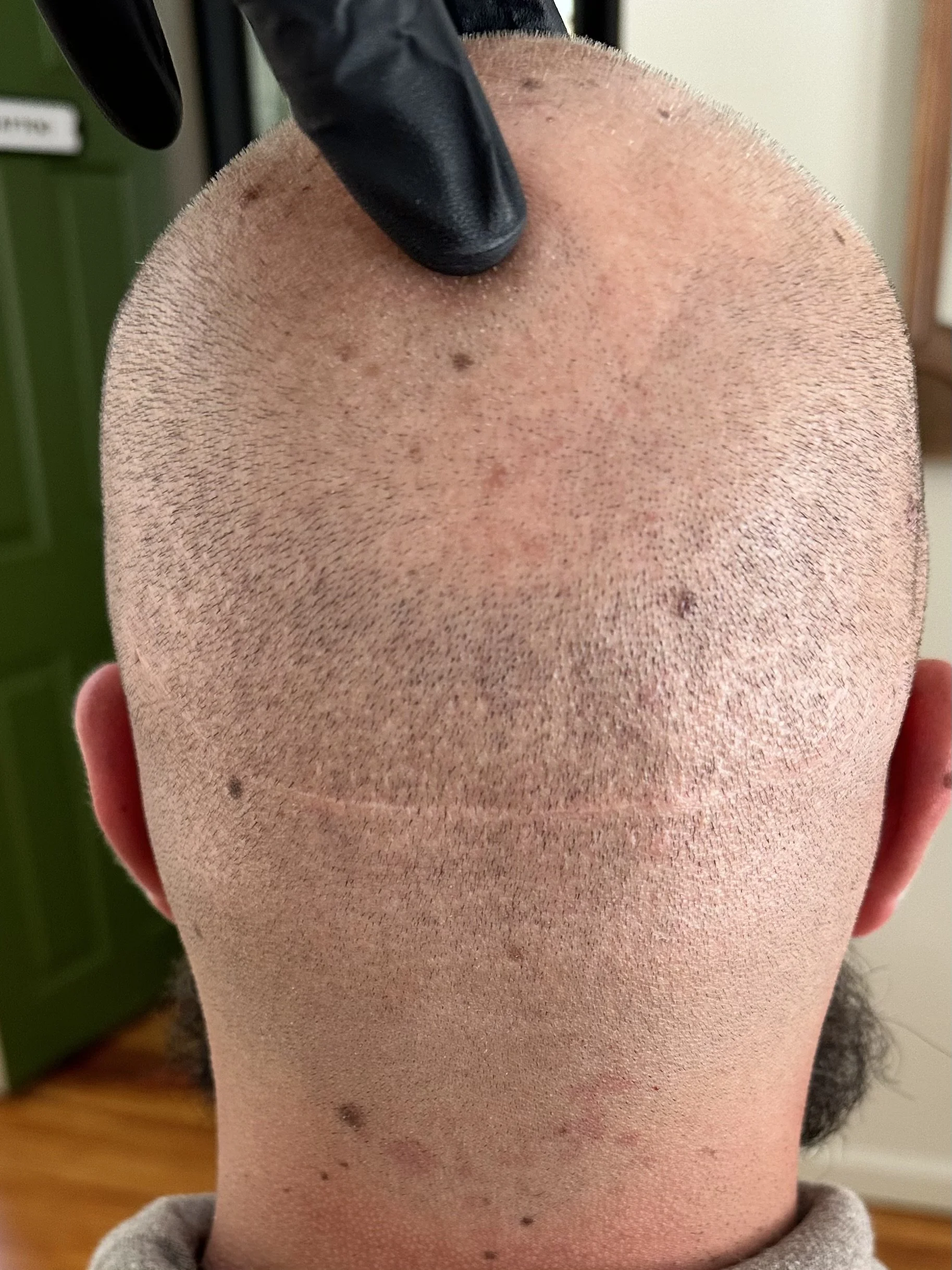 Scalp Micropigmentation for Hair Transplant Scars