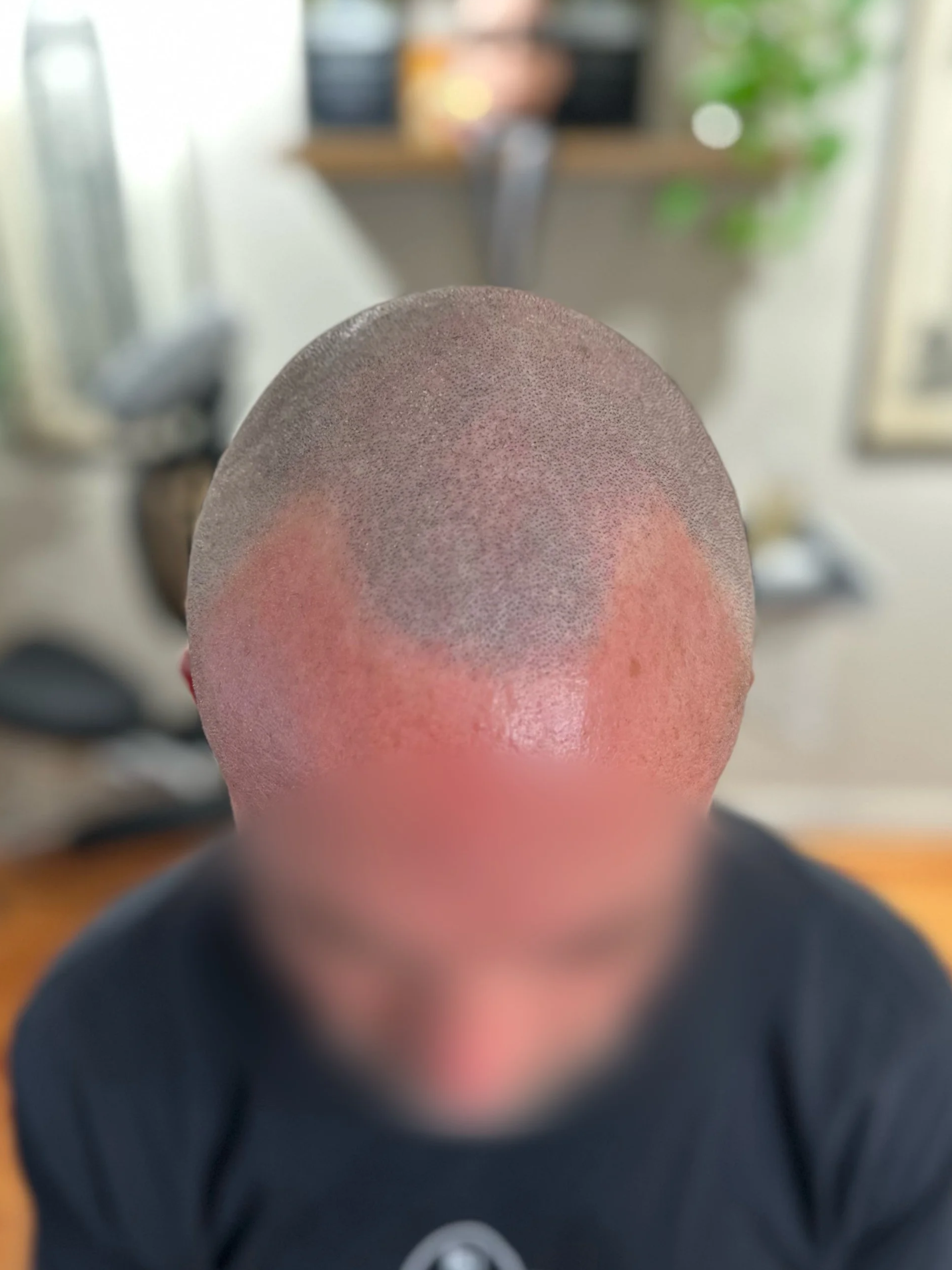        The Norwood Scale: What Stage of Hair Loss Are You In?