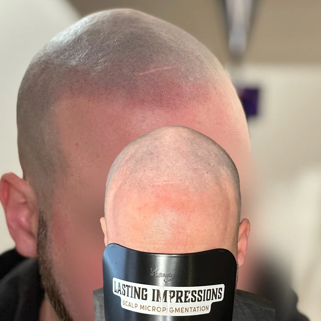 Close-up scalp micropigmentation result showing natural follicle simulation, Bucks County client, Lasting Impressions SMP