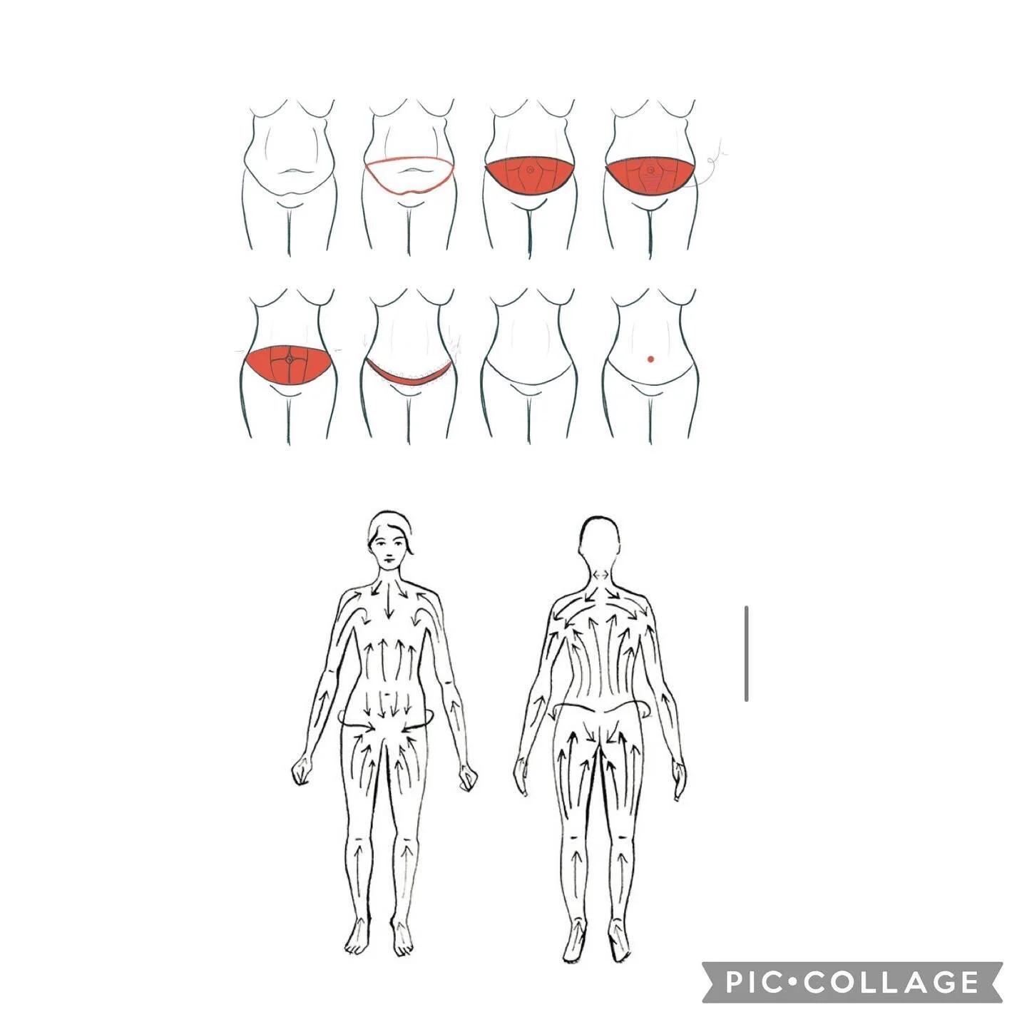 Understanding what happens to your LYMPHATIC SYSTEM when you have a TUMMY TUCK: top image shows the removal of the &lsquo;flap&rsquo; of skin at and below the belly button&mdash; second image shows the direction of flow at and below the belly button 