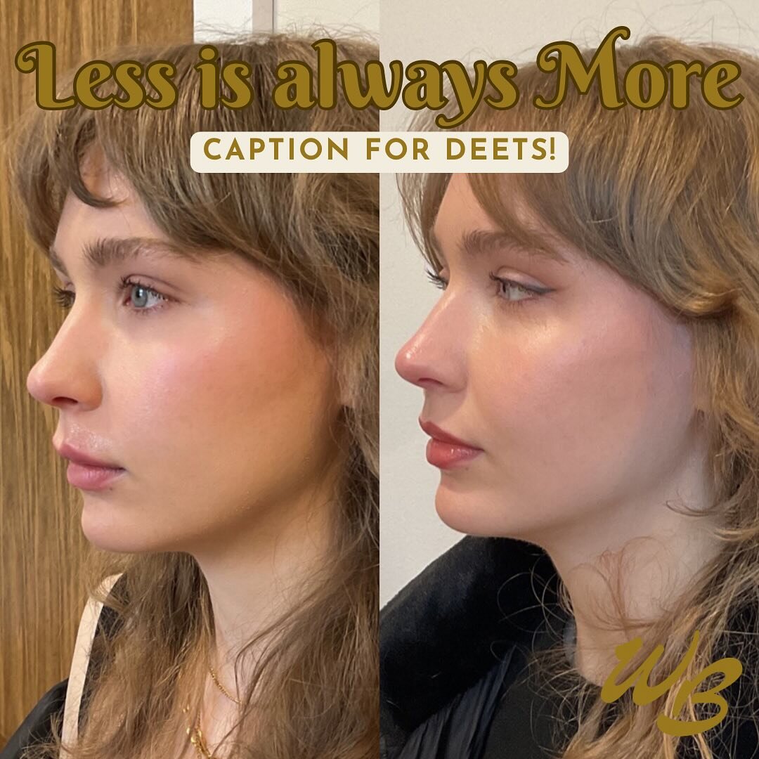Facial balancing w/ Dysport &amp; bye bye migrated lip filler 🧚

This pretty lady wanted to balance her beautiful features by adding more lip filler &amp; I said, way-way-waitttt☝🏻let&rsquo;s try this instead. 😊

In my book, consults and taking ex
