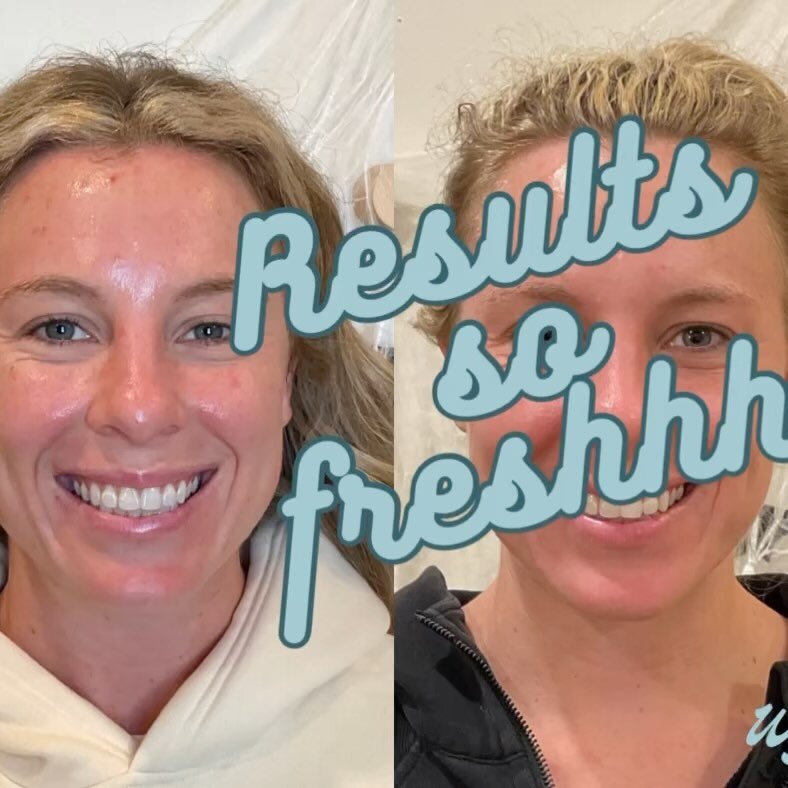 SWIPE FOR RESULTS 👏🏻👏🏻

For this beautiful client we were able to see improvement (reduced pore congestion, breakouts &amp; post inflammatory hyperpigmentation) with just one treatment.🫶🏻 Super excited to see more progress &amp; will continue t
