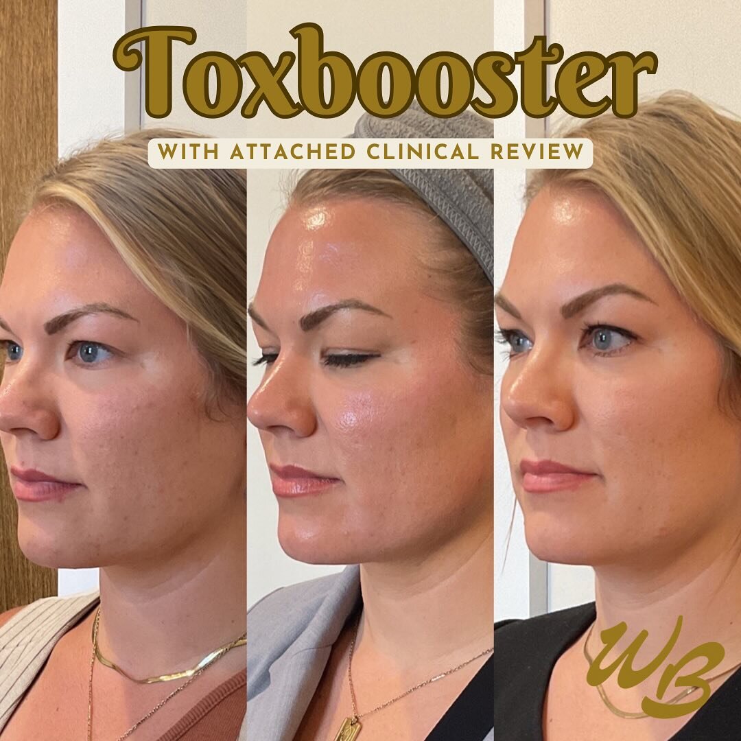 Lil B&amp;A action with an article on the peels I adore &amp; use every day! 🧖&zwj;♀️

Take a looksie &amp; save for reference. 

☝🏻What&rsquo;s a Toxbooster?
A superficial chemical peel prior to neuromodulator injections (aka Tox)

☝🏻How often?
E
