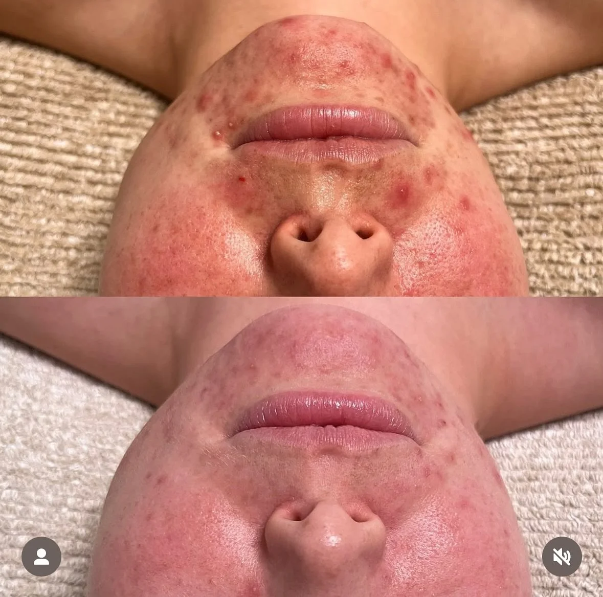 Seeing is believing! 

We love to showcase our key partners work and these results were achieved in 3 months using @nimueskininternational Purifying Range. 

DM us if you have skin like this 

@skinvaenz