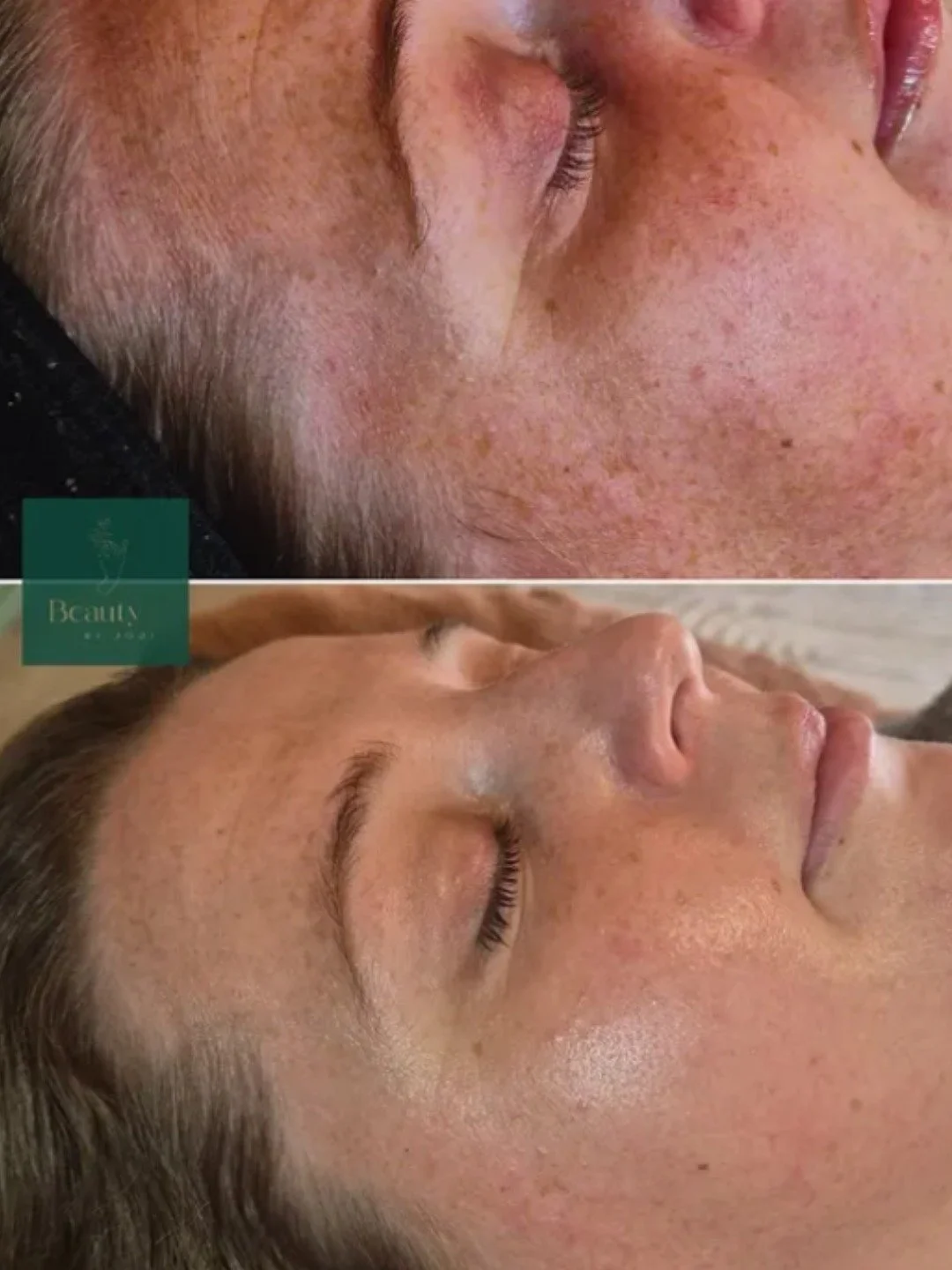We love celebrating the incredible results our salon partners achieve with their clients. This beautiful transformation by Beauty by Jodi shows the power of a consistent 9-month skin journey leading up to her client&rsquo;s wedding day.

Using Nimue 