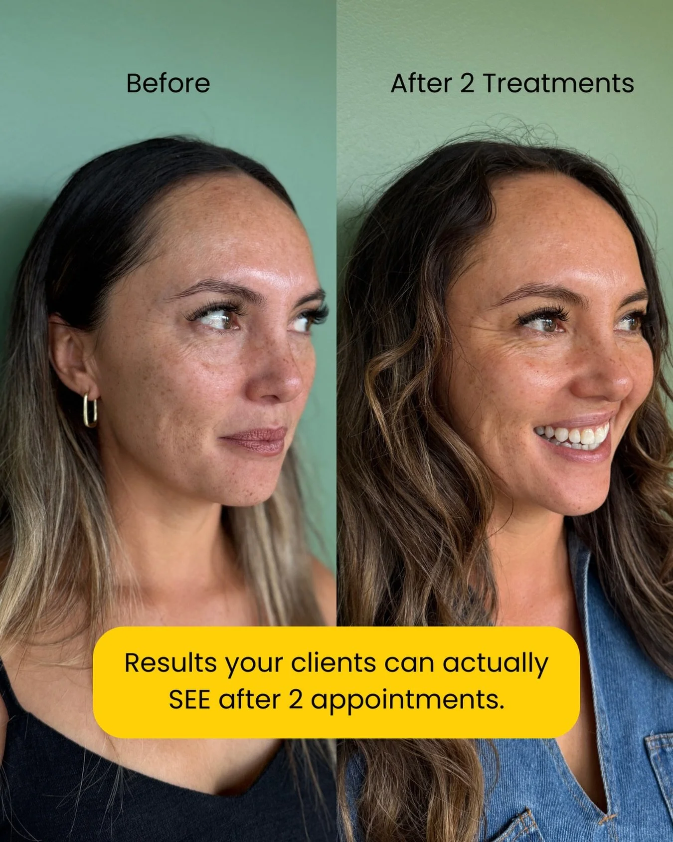 This is the power of SQT Bio-Microneedling, a treatment designed to support skin renewal from within using 100% natural siliceous spicules to stimulate regeneration and improve overall skin health.

Why salons are loving SQT:
✔ Helps improve skin tex