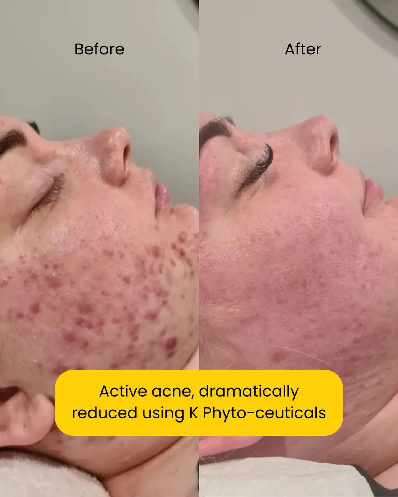 Acne Skin Treatment. This is why we do what we do.

Our salon partner @citrinebeautystudio has achieved incredible results for their client using K Phyto-ceuticals professional treatments combined with a tailored homecare programme, dramatically redu