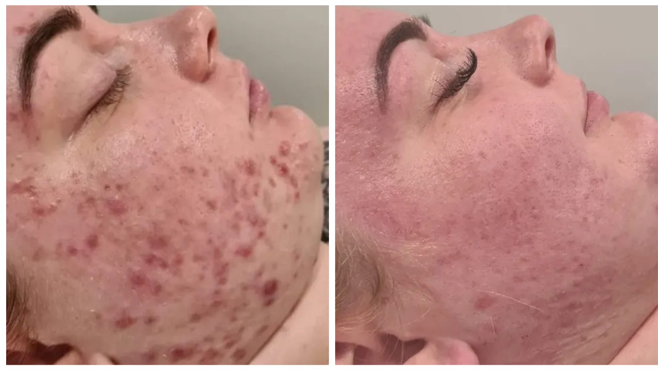 k phyto before and after