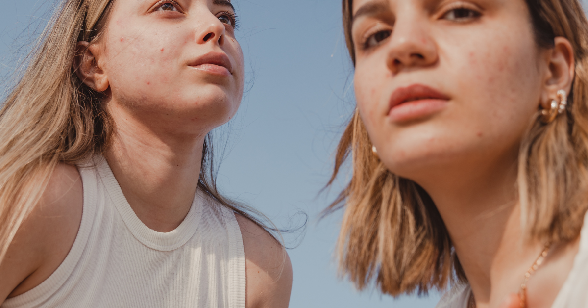 Acne prone skin solutions can help to relieve the pain, discomfort, and embarrassment of acne.