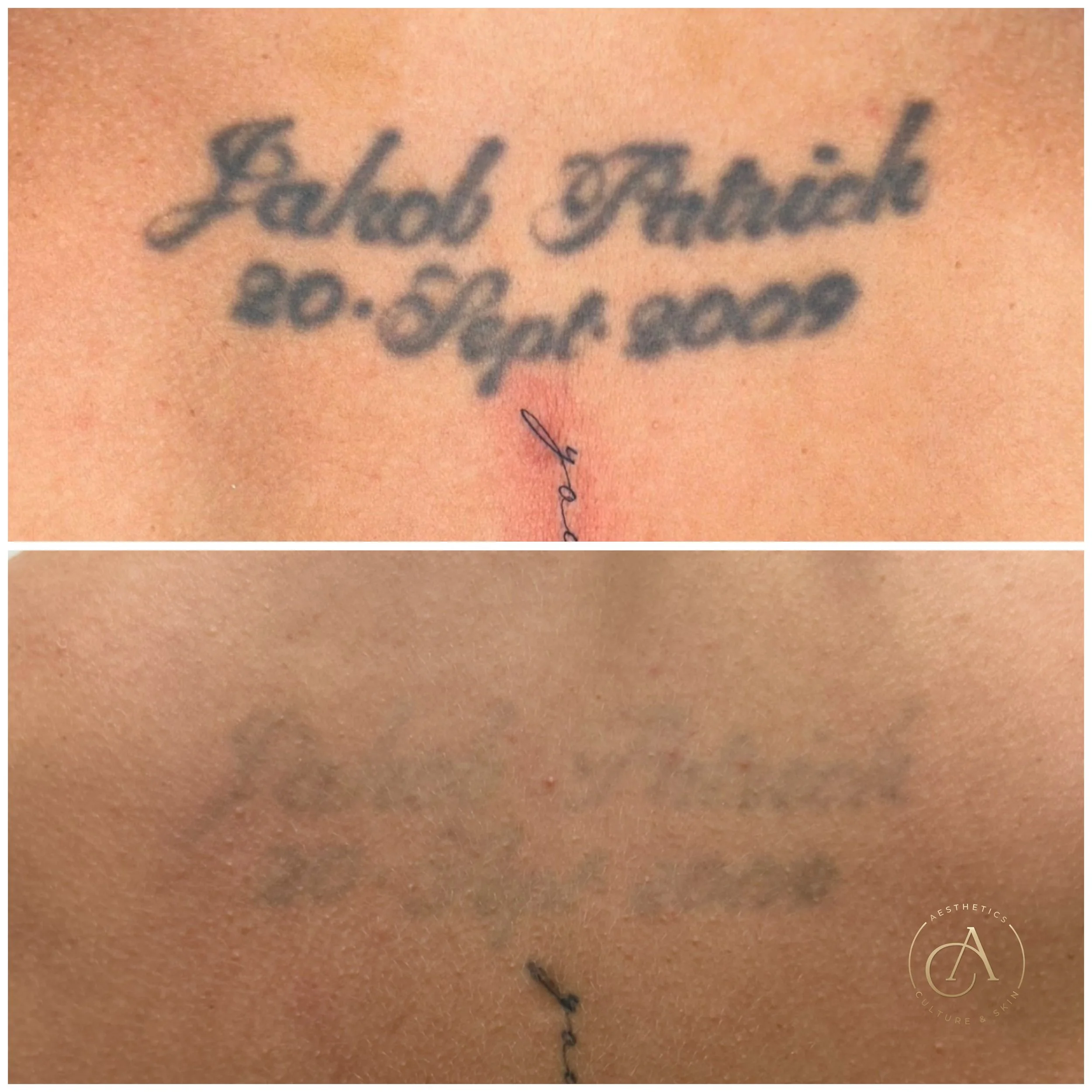 tattoo removal adelaide