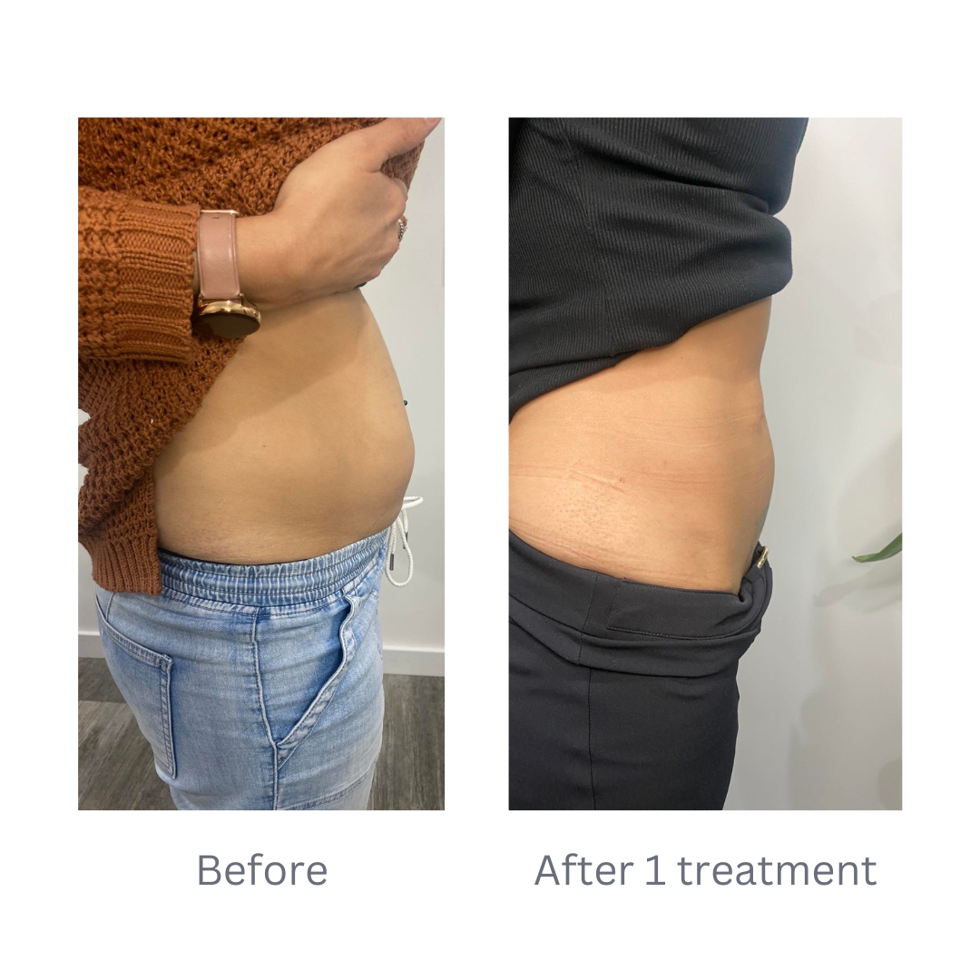 Comparison of a person's abdominal area before and after one treatment showing a reduction in stomach size and size discrepancy.