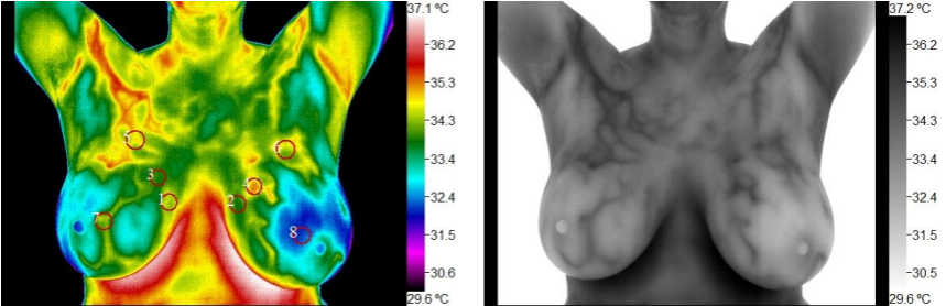 A view of a breast thermograph