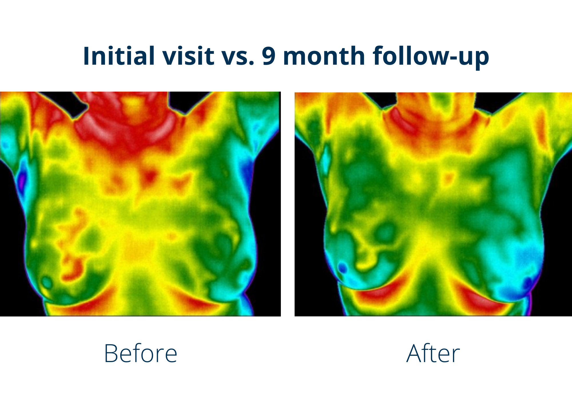 breast thermography scan at Leawood Thermography before and after