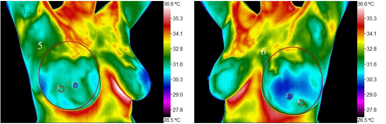 Thermal images of a woman's upper torso showing temperature variations with color coding.