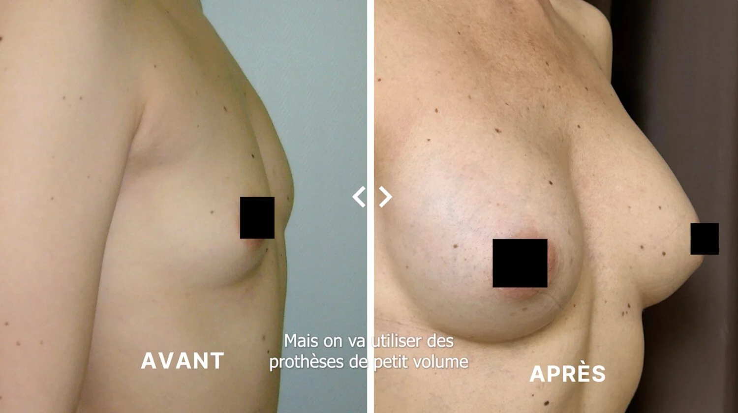 Chirurgie esthétique, la demande de naturel