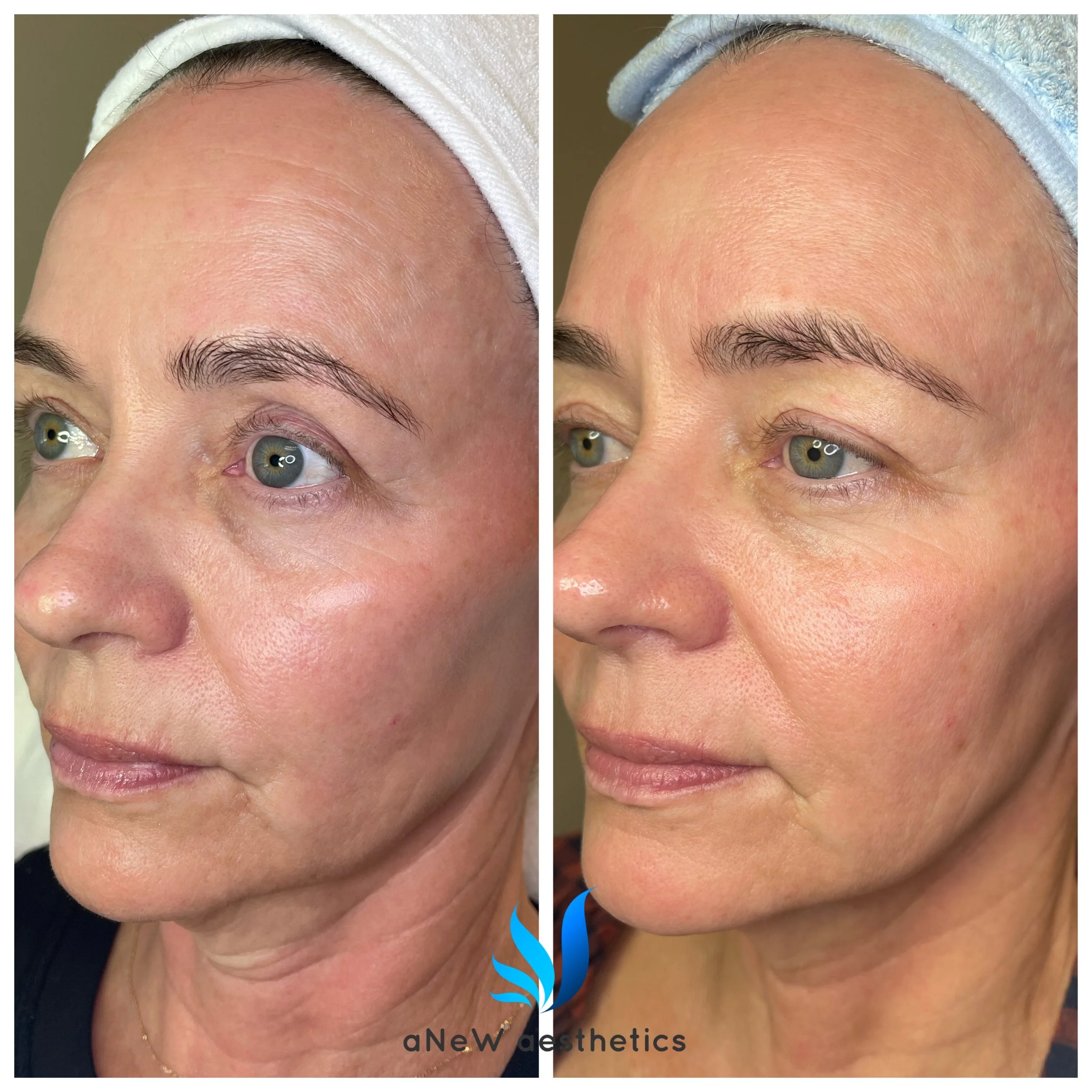 Side-by-side comparison of a woman's face showing improvement in skin texture; before and after skincare or aesthetic treatment, with clear skin, fine lines reduced, and a more radiant complexion.