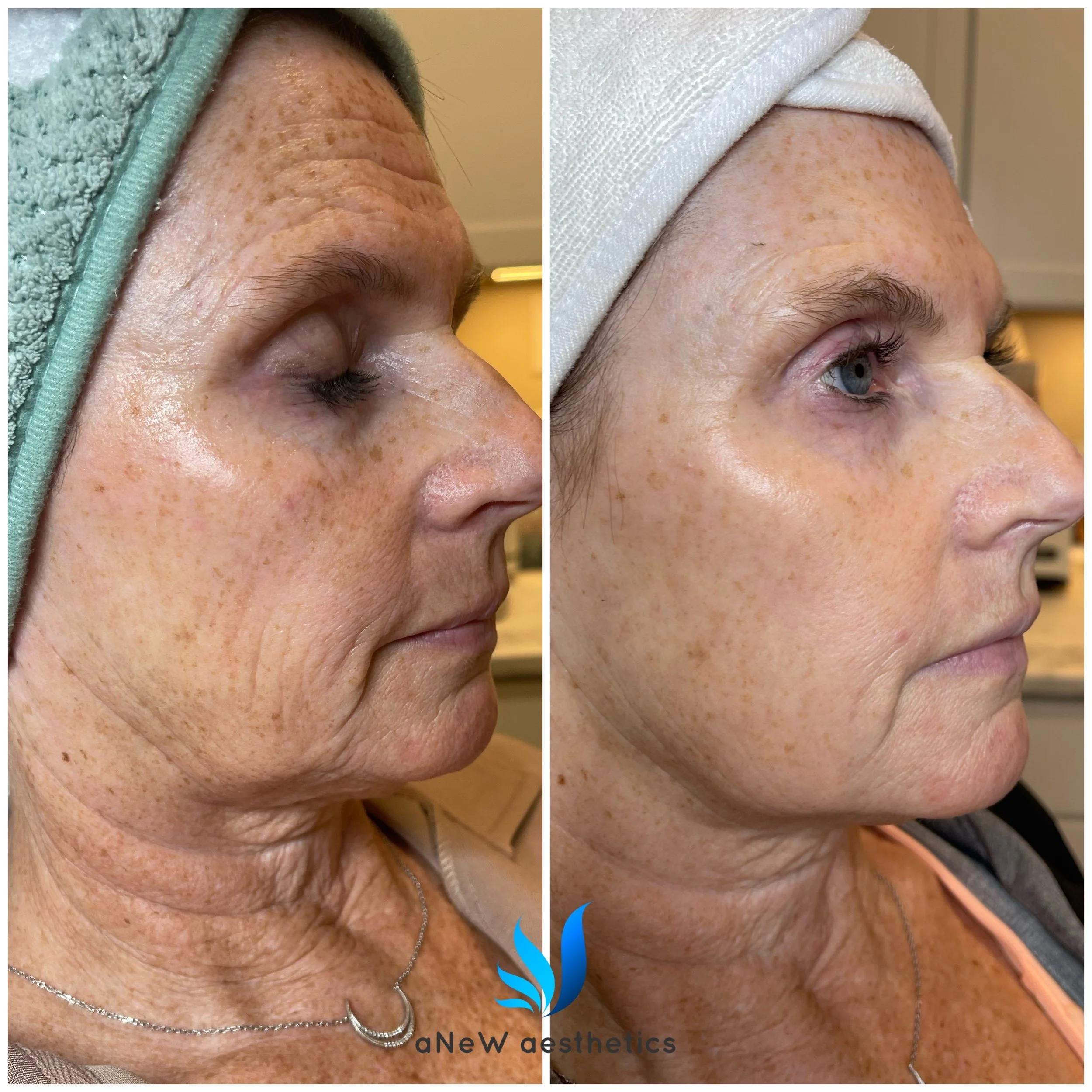 Side-by-side comparison of a woman's face before and after skincare treatment, showing reduced wrinkles, improved skin texture, and a more youthful appearance.