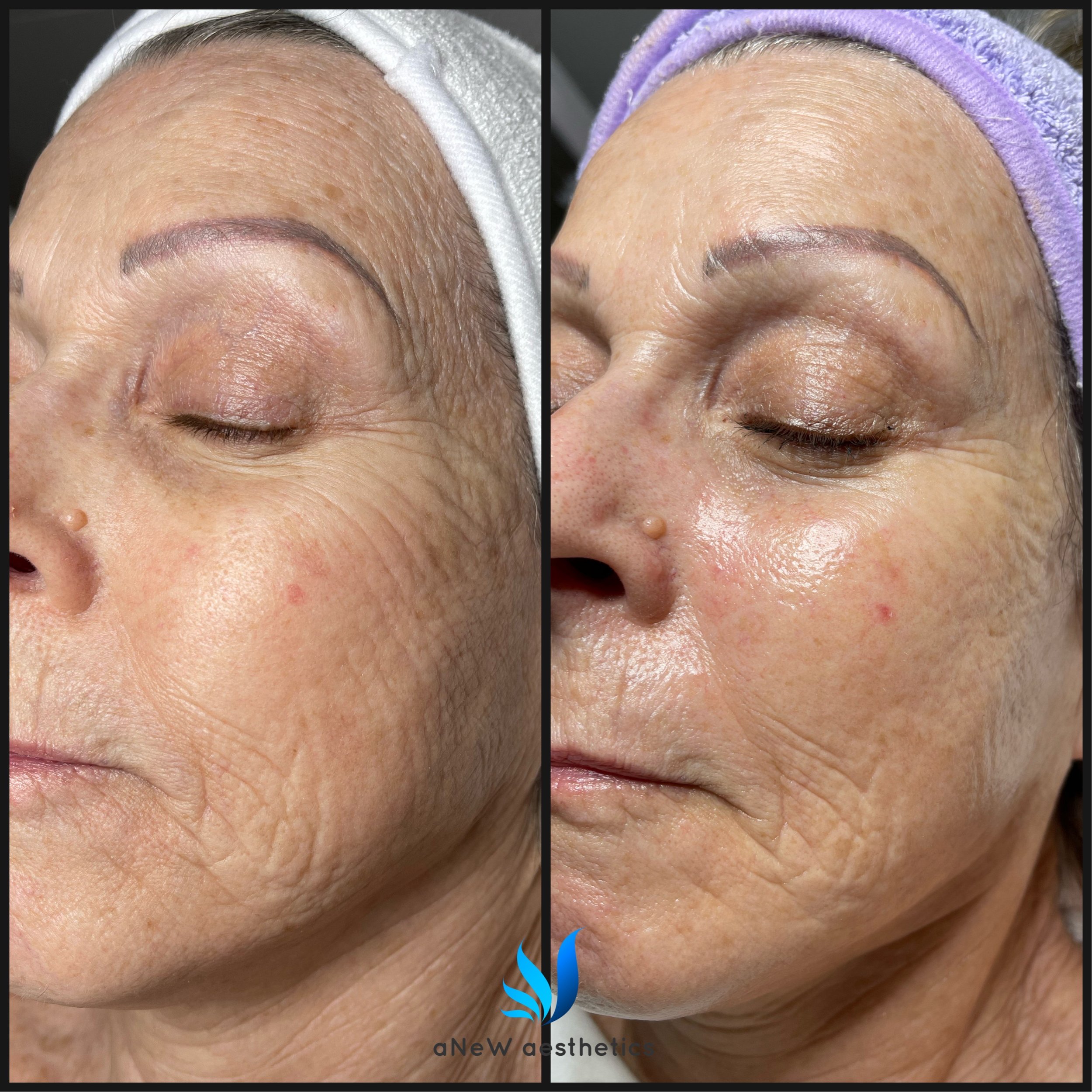 Side-by-side comparison of a woman's face showing skin before and after a cosmetic treatment, highlighting improved skin texture and reduced wrinkles.