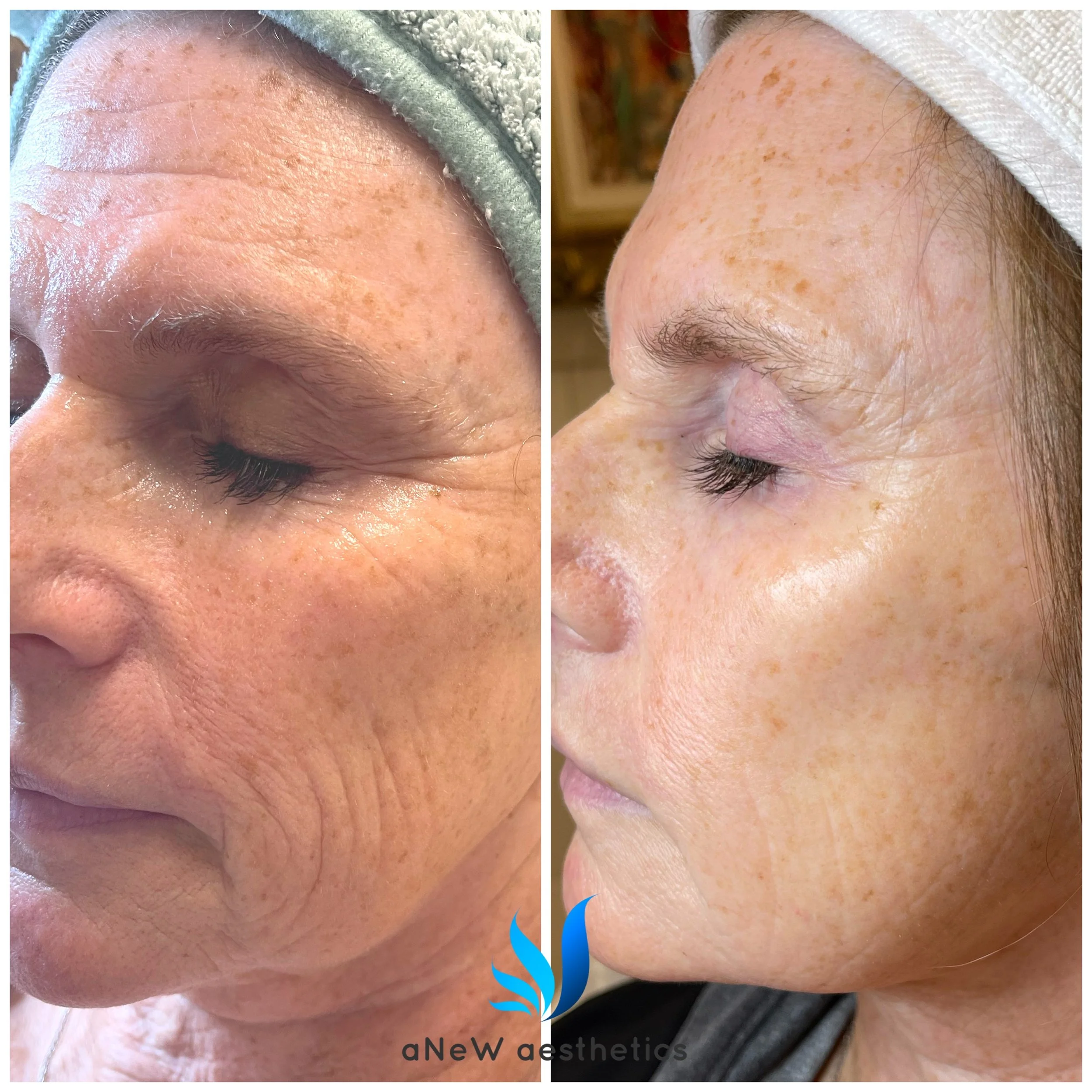 Side-by-side comparison of a woman's face showing before and after skincare treatment, highlighting improved skin texture and reduced pigmentation.