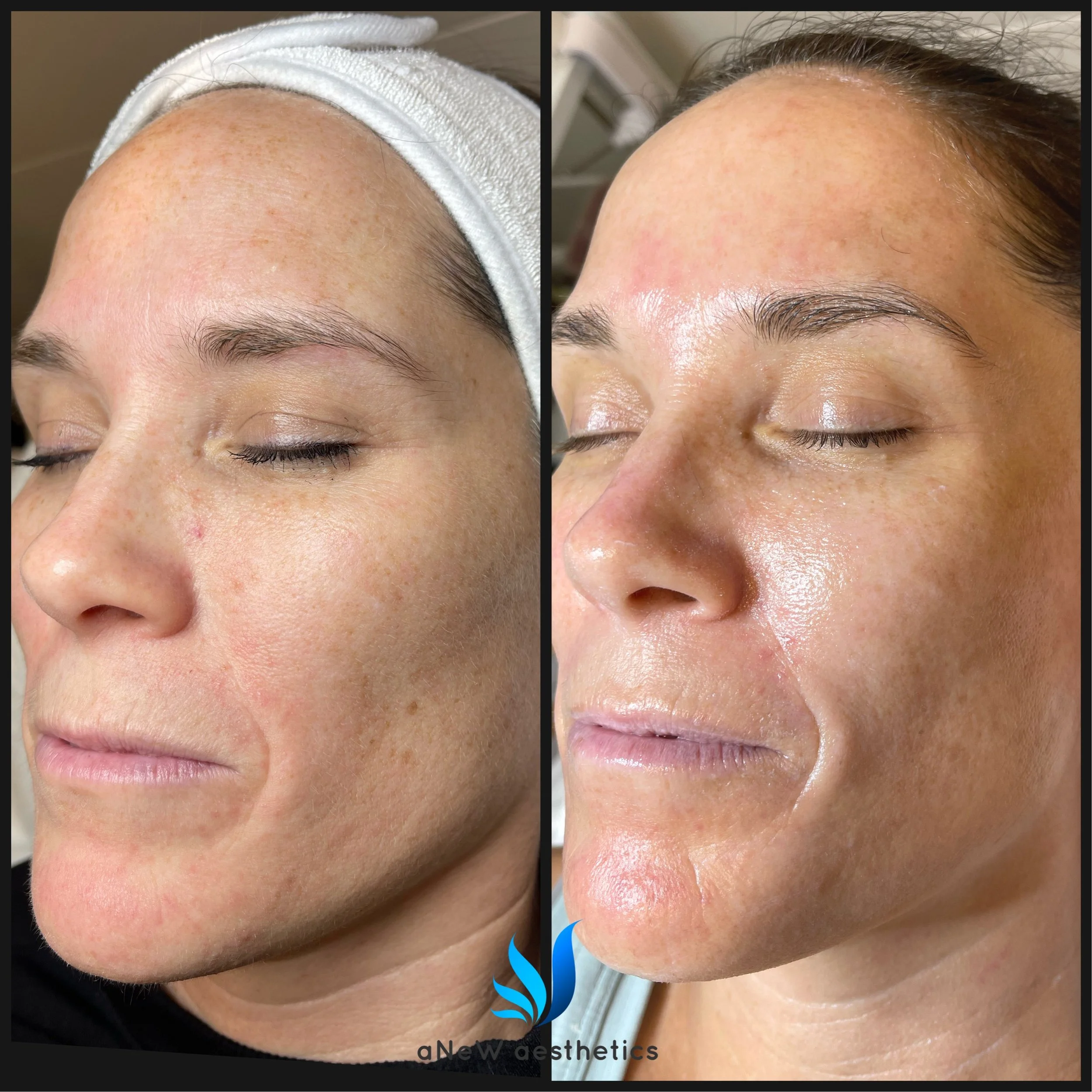 Side-by-side comparison of a woman's face before and after a skincare treatment, showing improved skin texture and glow.