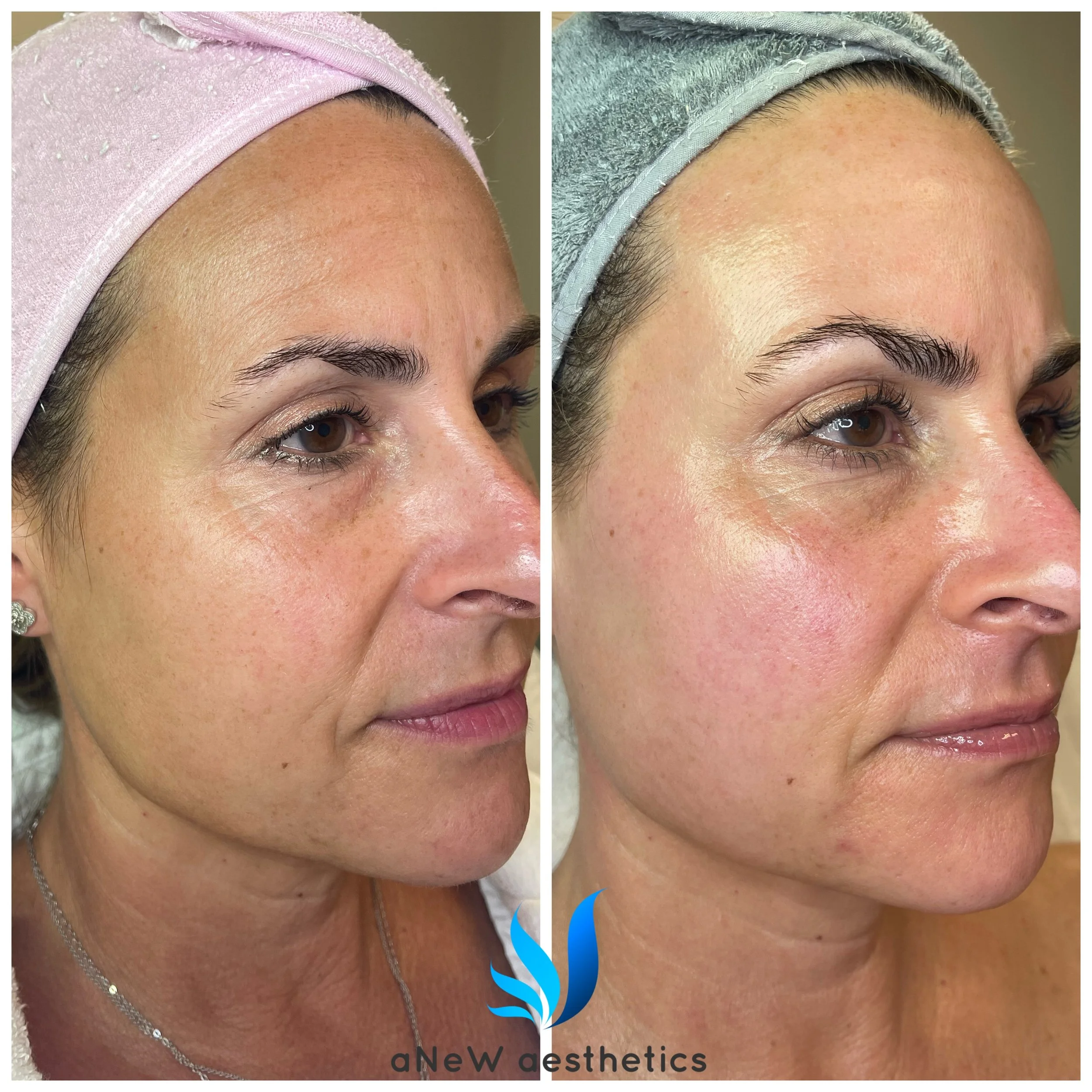 Side-by-side before and after close-up photos of a woman's face showing improved skin texture and reduced pigmentation after a cosmetic treatment, with the logo 'aNew aesthestics' at the bottom.