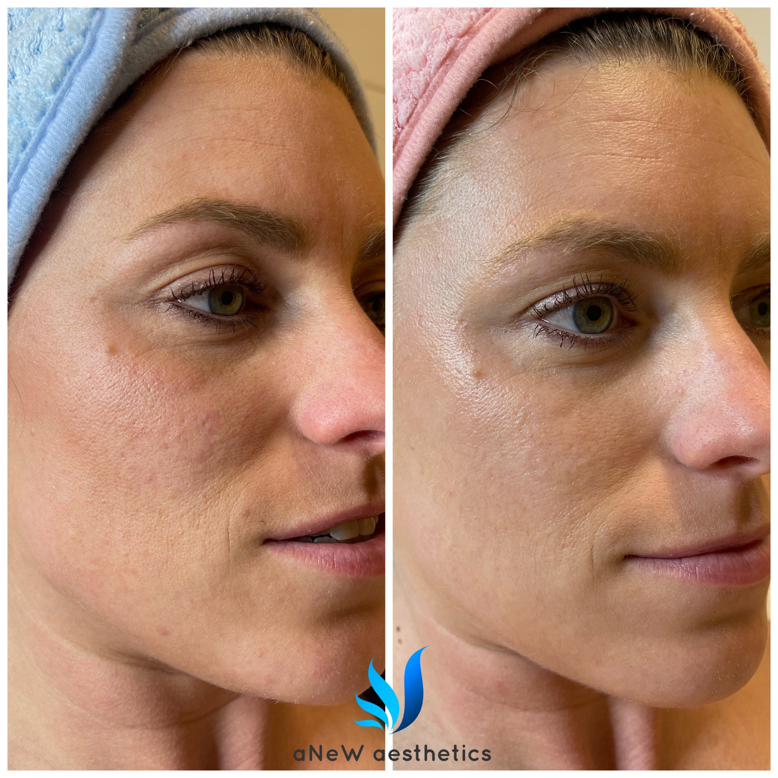 Side-by-side comparison of a woman's face before and after skin treatment, showing improved skin texture and reduced blemishes.