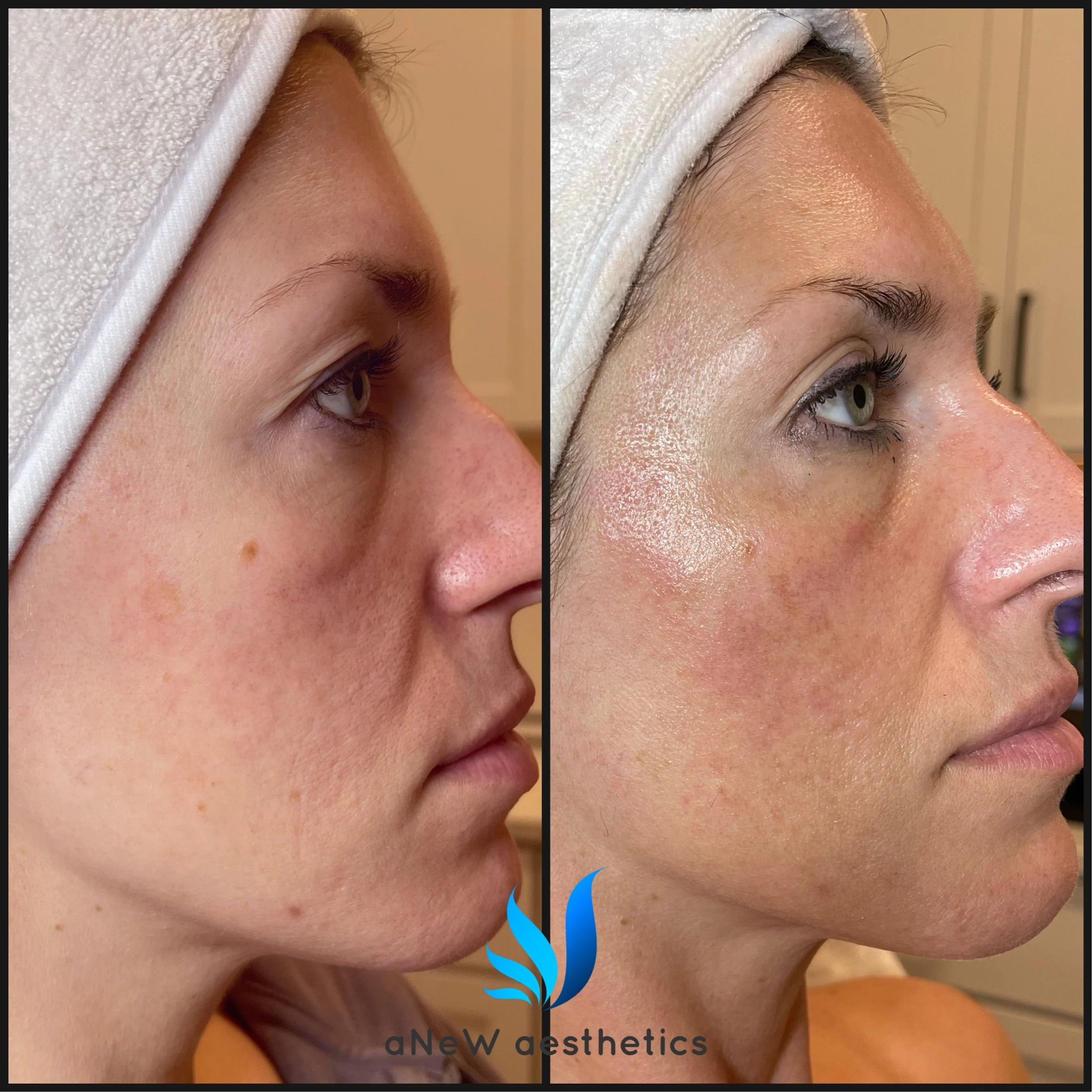 Side-by-side comparison of a woman's face before and after a skincare treatment, showing improved skin texture and glow. The woman has light skin, light eyes, and is wearing a white head towel.