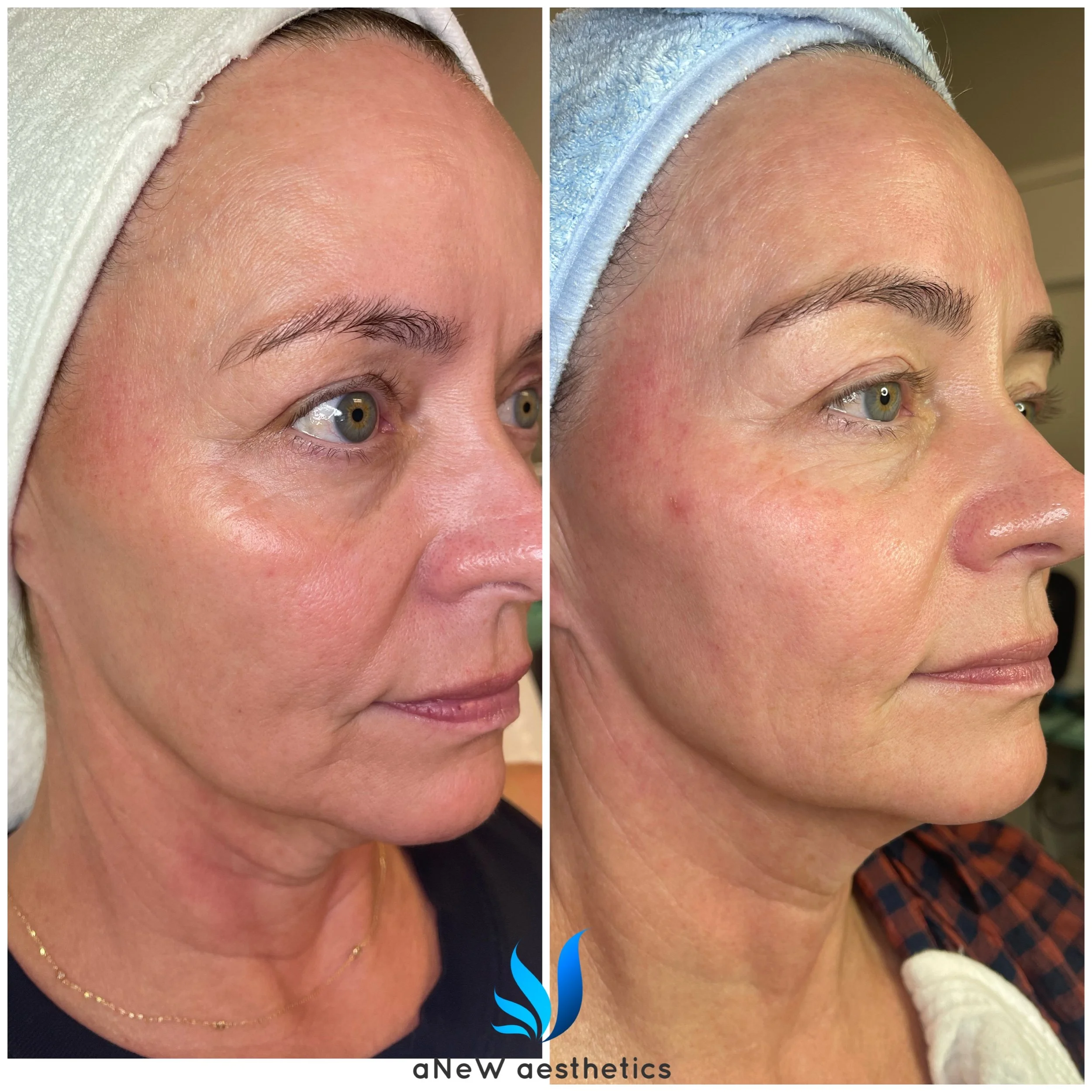Side-by-side comparison of a woman's face before and after cosmetic treatment, showing improvements in skin texture and appearance.