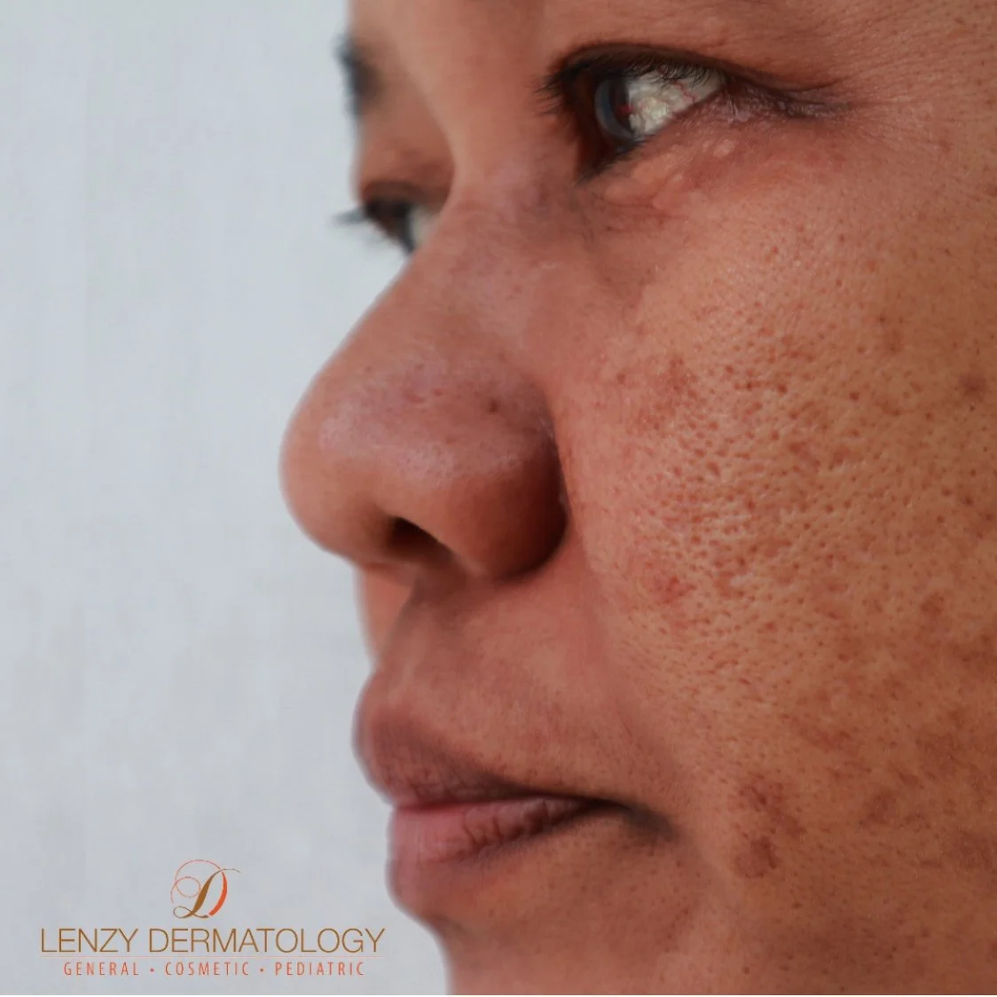 Understanding Hyperpigmentation/Melasma