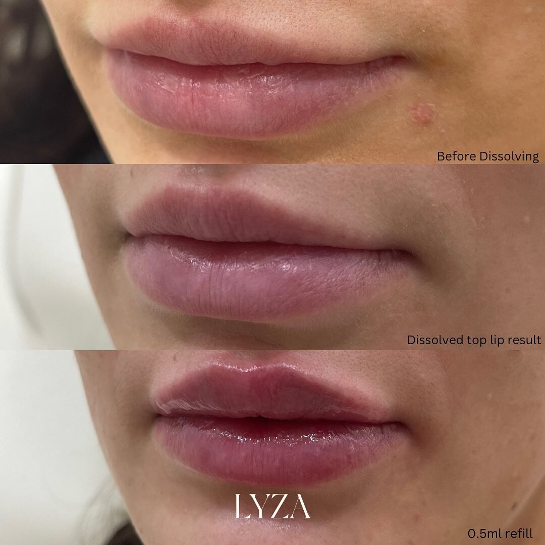 ❤️ Dissolve and Refill ❤️

Our client had migration/lumps from previous practitioners and wanted to start fresh with her lips. 

We dissolved the top lip and the migration in the border then re-injected 1 month later, the pictures above show the proc